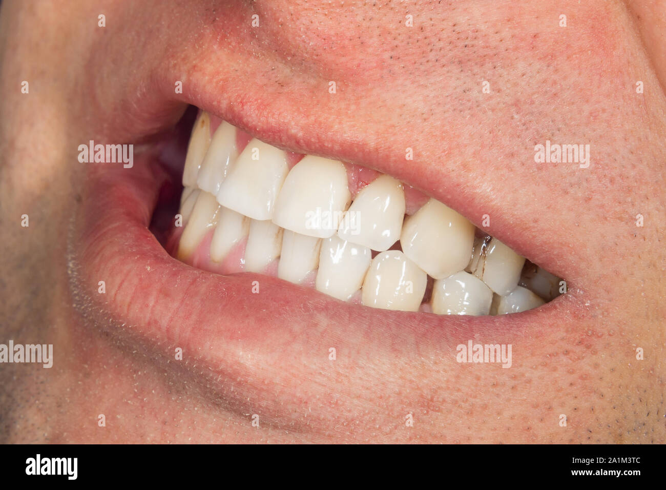 Zähne, die Nahaufnahme Makro. Hygiene der menschlichen Mundhöhle nach Zulassung zum Zahnarzt Stockfoto