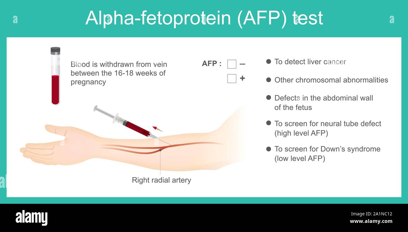 Der Alpha-fetoprotein-AFP-Test. Die Analysen auf der Ebene von AFP. Leberkrebs zu erkennen, und verwenden Sie für Down Syndrom. Stock Vektor