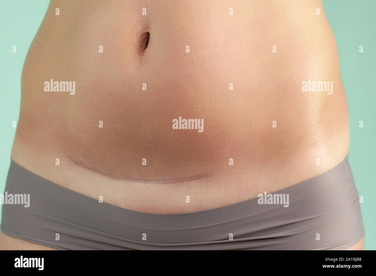 Nahaufnahme von einem Kaiserschnitt Narbe in eine Frau. Gesundheit und  Geburt Stockfotografie - Alamy