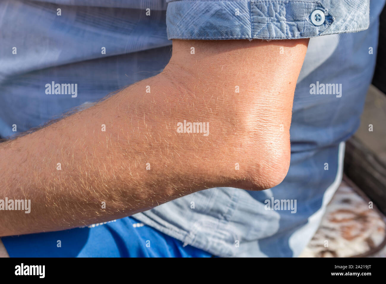 Entzündete Bursa am Ellenbogen eines Mannes Stockfoto