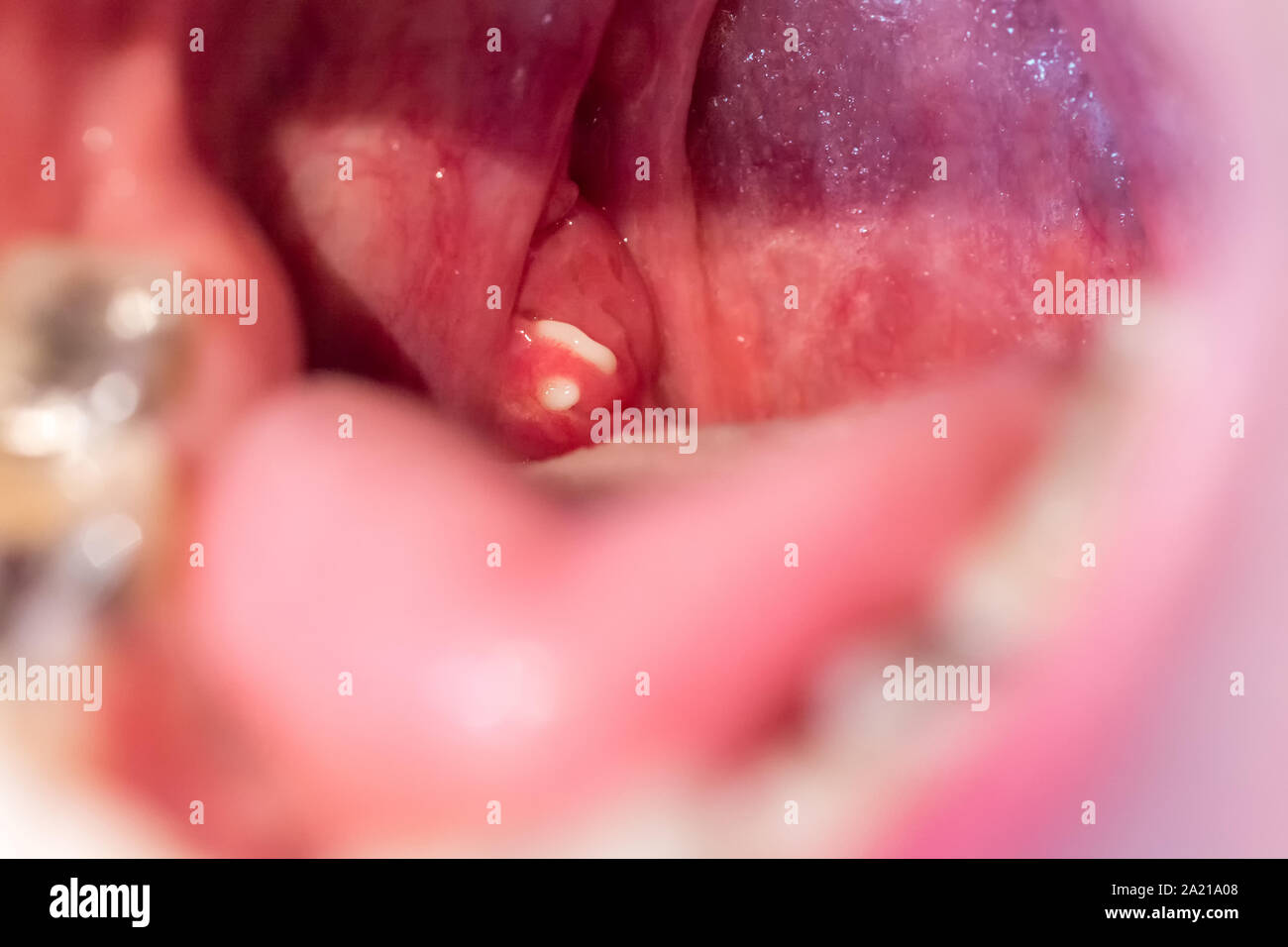 Weiße Mandel Steine auf die gaumenmandeln als Auslöser des schlechten Atems Stockfoto