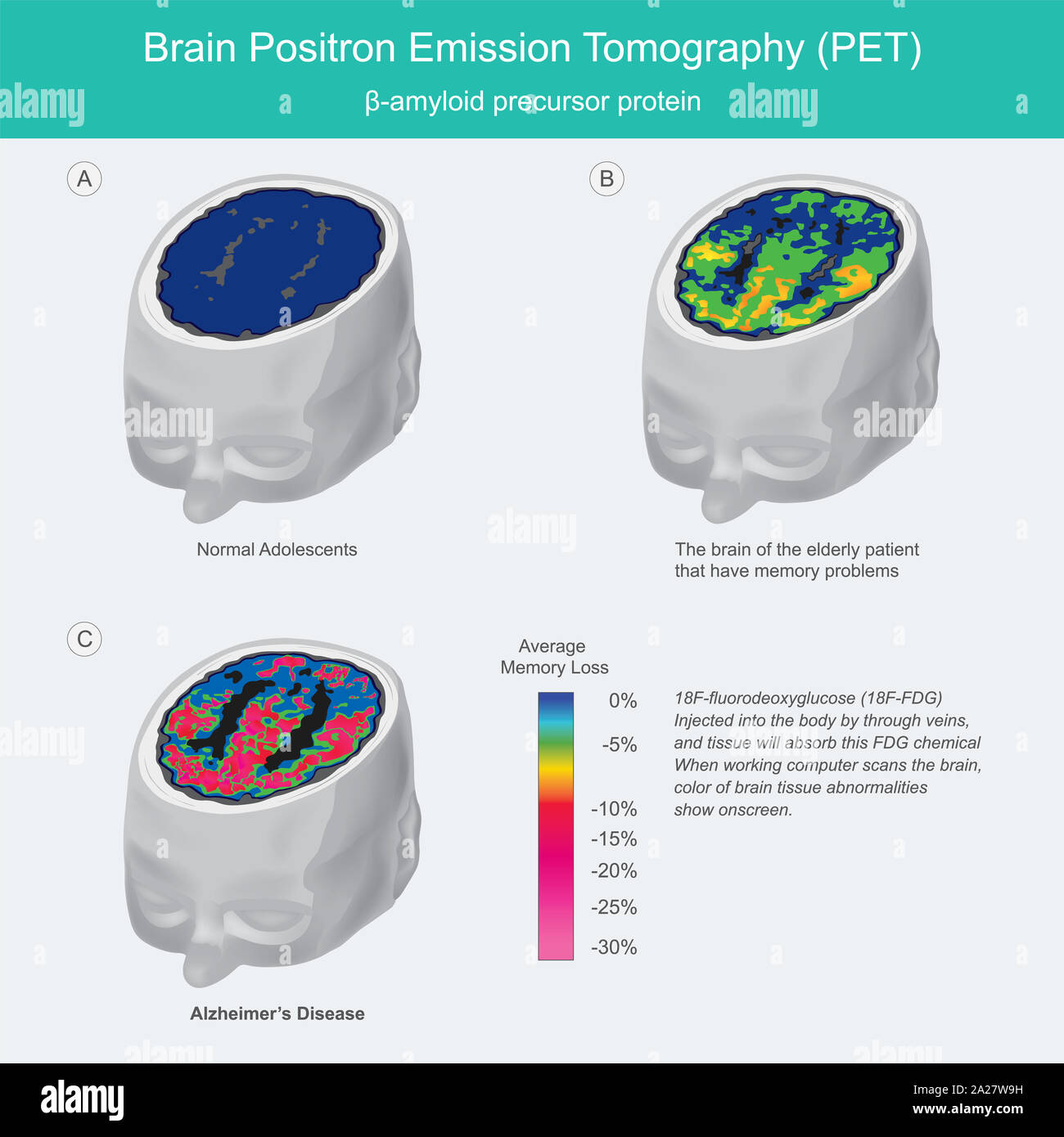 Gehirn PET-Scans. Bei der Arbeit Computer scannt das Gehirn, Farbe des Gehirngewebes Auffälligkeiten zeigen, die am Bildschirm angezeigt werden. Stockfoto