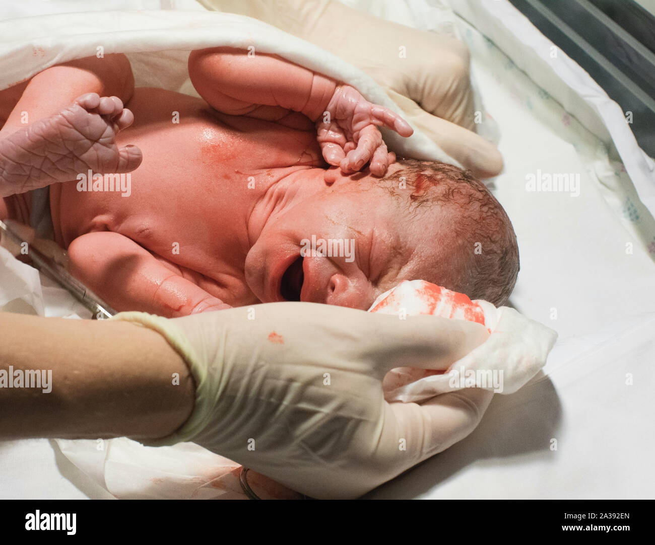 Neugeborenes Baby im Krankenhaus mit einer Nabelschnur und Weinen im Blut Stockfoto