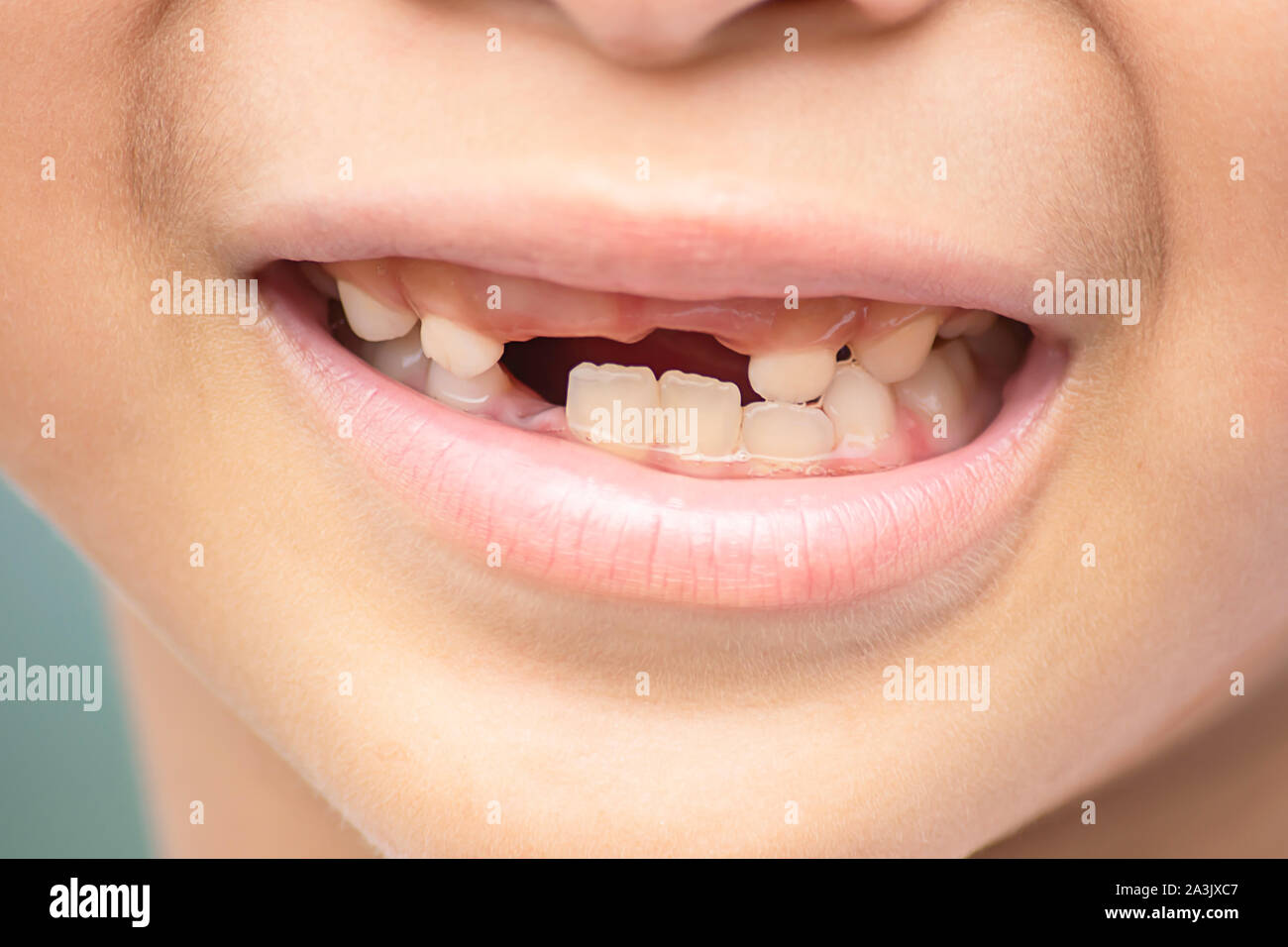 Baby Zähne sind gerade in den Mund fiel. Stockfoto