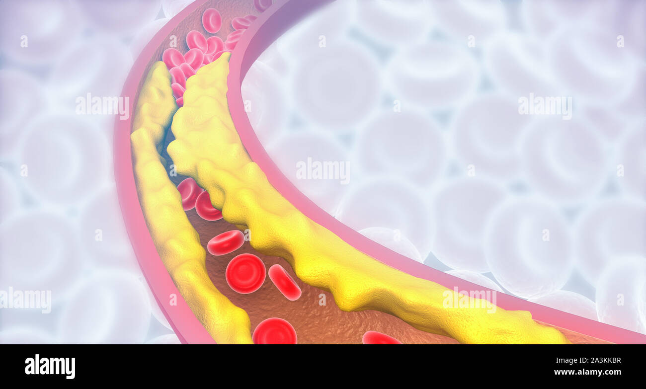 Arterie verstopft mit schlechtem Cholesterin. verstopfte Arterien, koronare Plaque. 3D-Darstellung Stockfoto