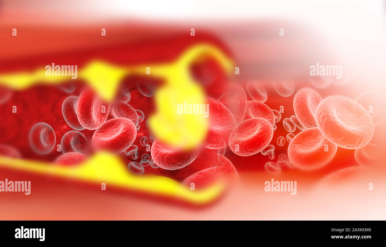 Arterie verstopft mit schlechtem Cholesterin. verstopfte Arterien, koronare Plaque. 3D-Darstellung Stockfoto