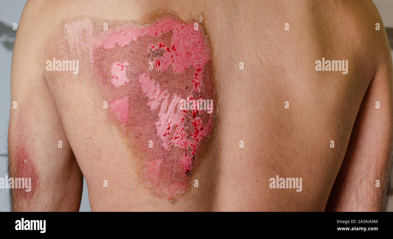 Verbrennung Zweiten Grades Stockfotos und bilder Kaufen Alamy