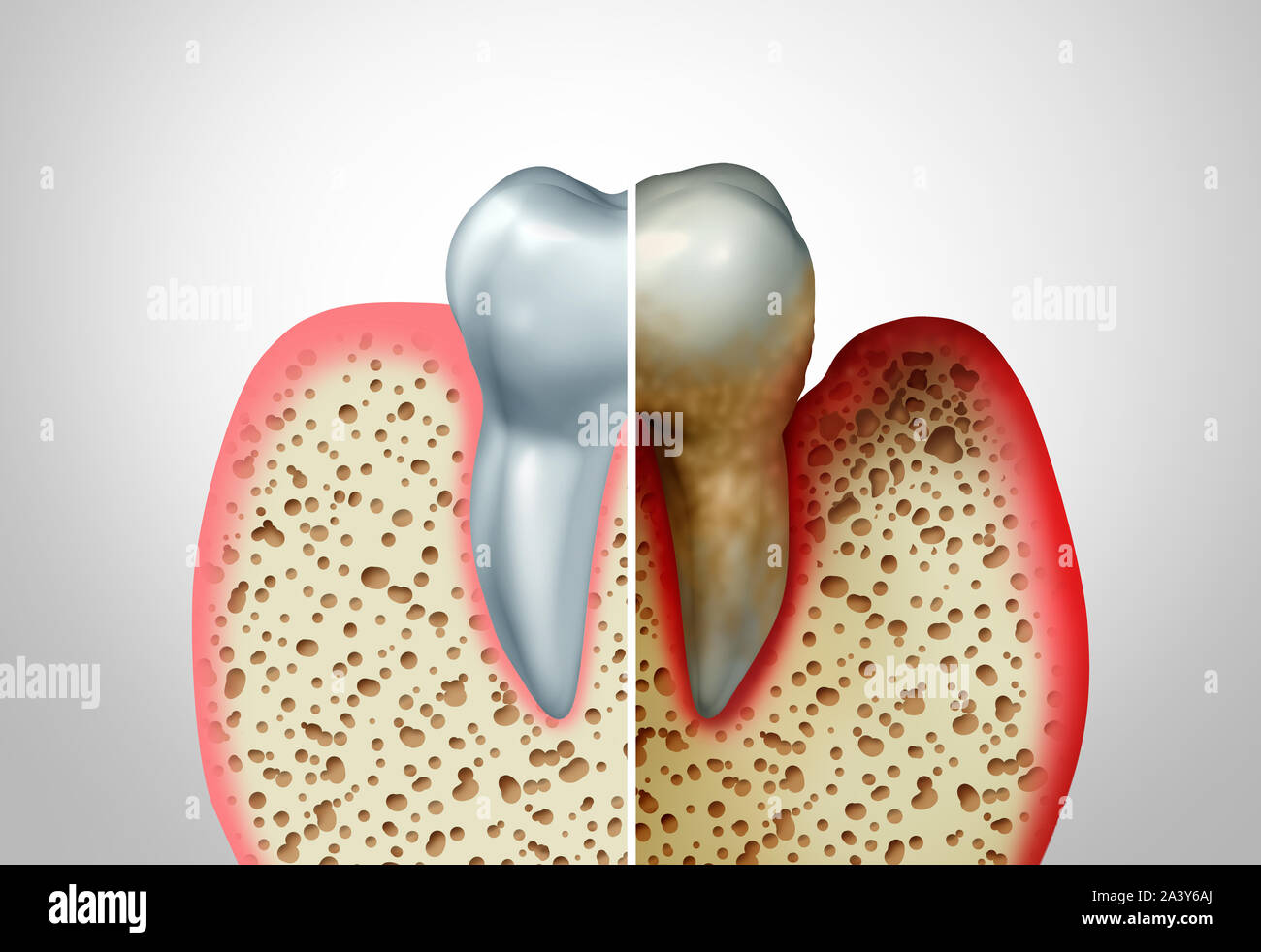 Gummi Krankheit im Vergleich mit einem gesunden Zahn und eine ungesunde mit Parodontitis und schlechte Mundhygiene Gesundheit Problem als Bakterien Infektion. Stockfoto