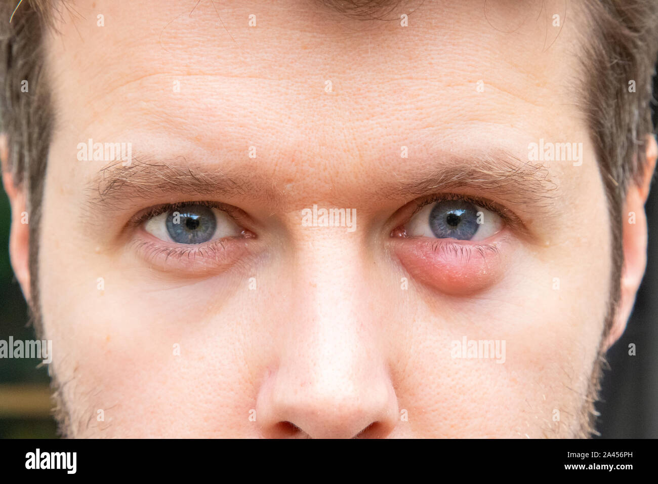 Geschwollenes auge Fotos und Bildmaterial in hoher Auflösung Alamy