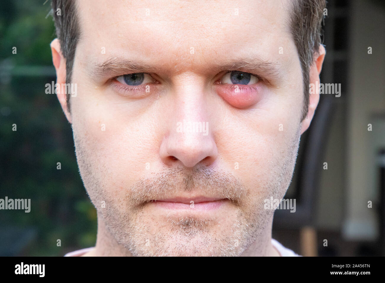 Ein Mann mit einer geschwollenen Lid aufgrund einer Infektion. Stockfoto