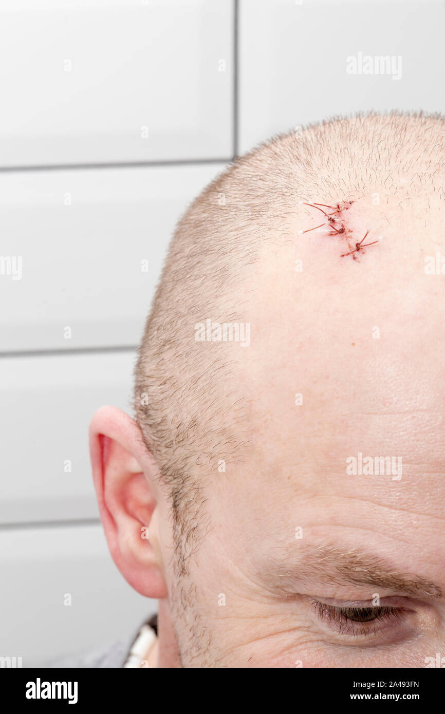 Auf den Kopf des Mannes Es ist eine Wunde mit Nadel und Faden, nach Verletzungen. Close-up. Stockfoto