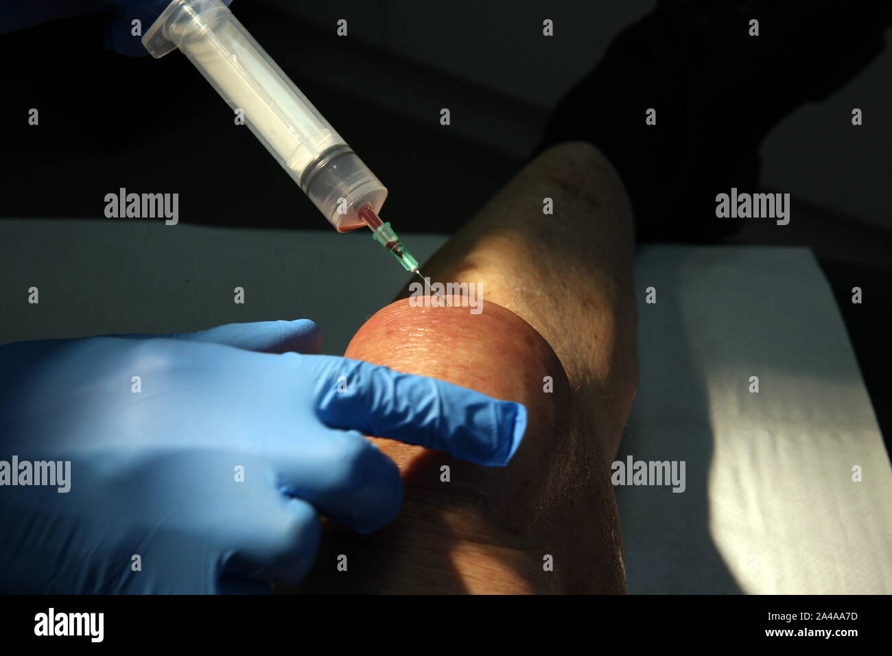 Bursitis Aspiration Stockfoto