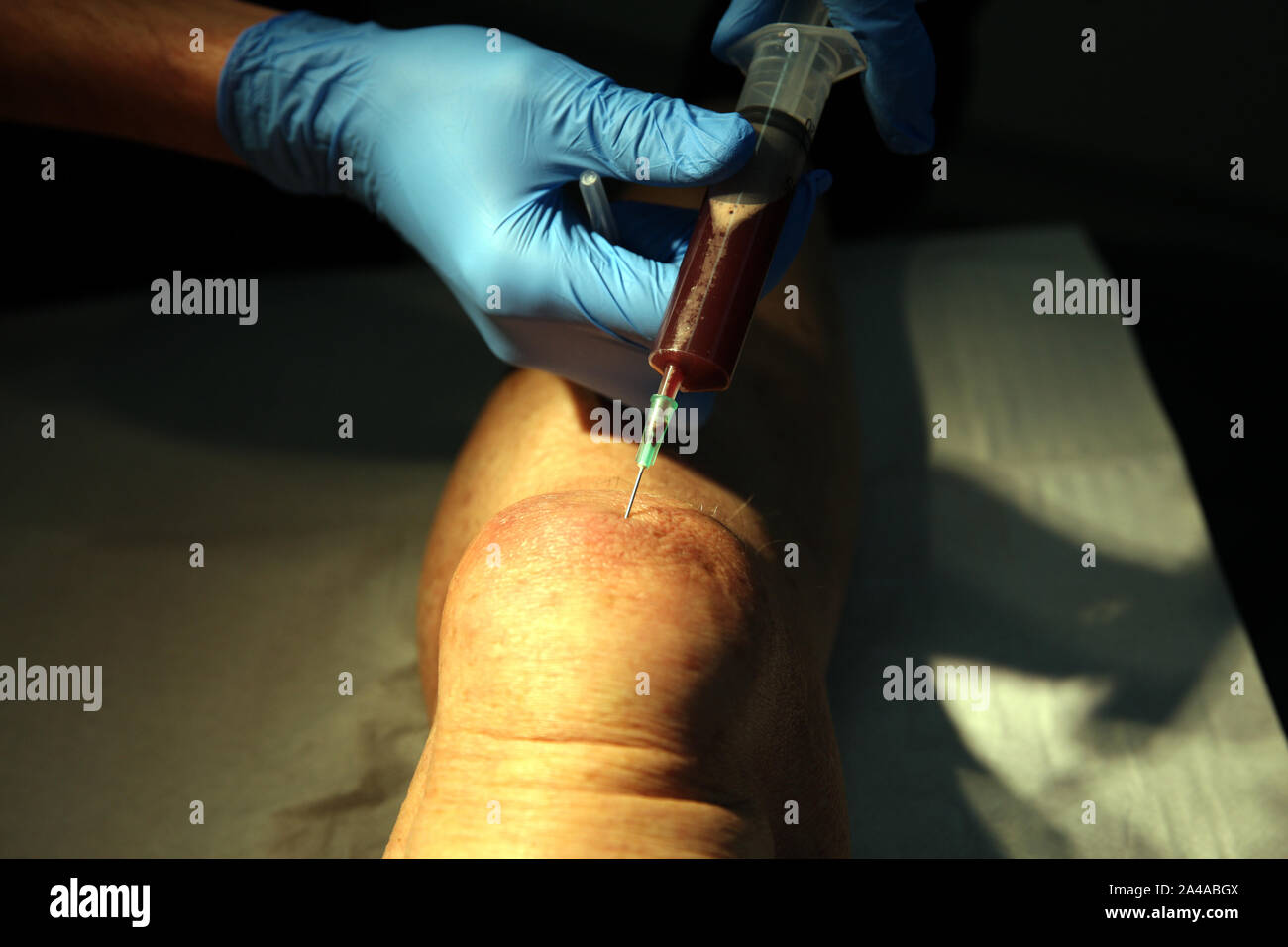 Bursitis Aspiration Stockfoto