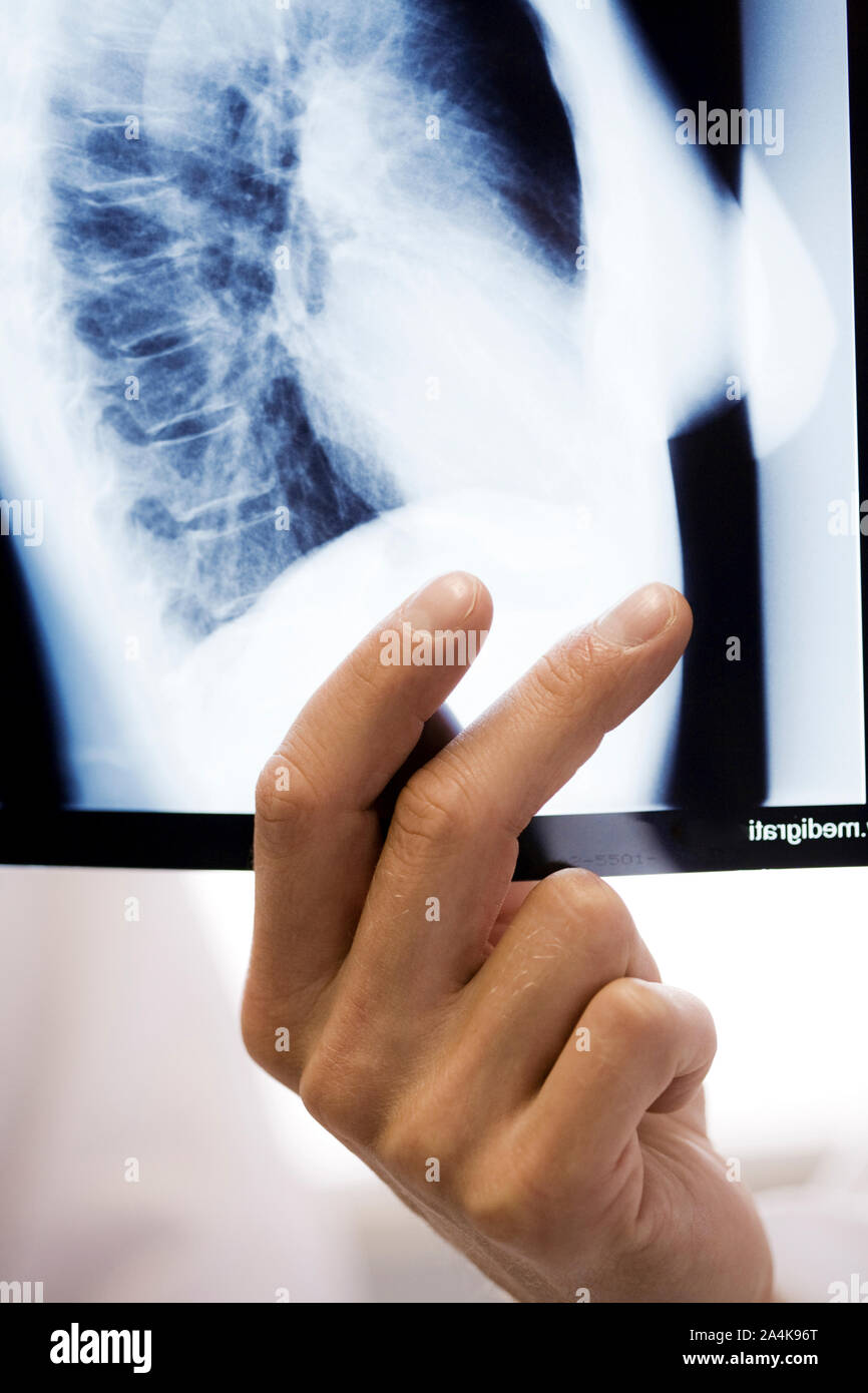 Männlicher Arzt eamining x-ray - Lungenkrebs Stockfoto