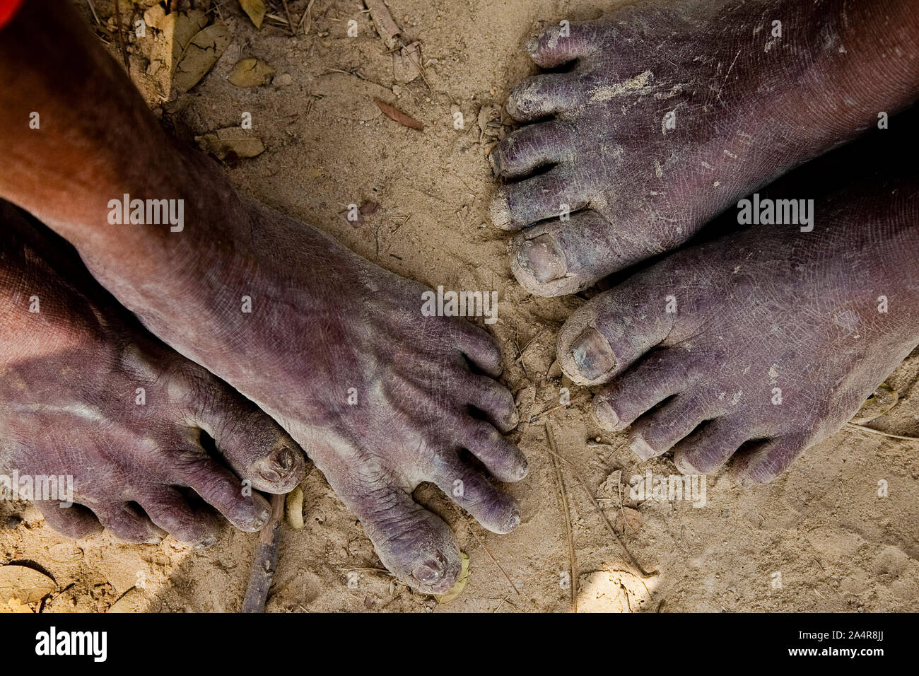 Füße barfuß Arbeitnehmer durchsetzt mit Pilz Infektionen aus dem Lehm. Die Arbeiter benutzen Rasierklingen aus zu Hautveränderungen wie keine Medikation kratzen ist, die Ihnen zur Verfügung stehen. Stockfoto