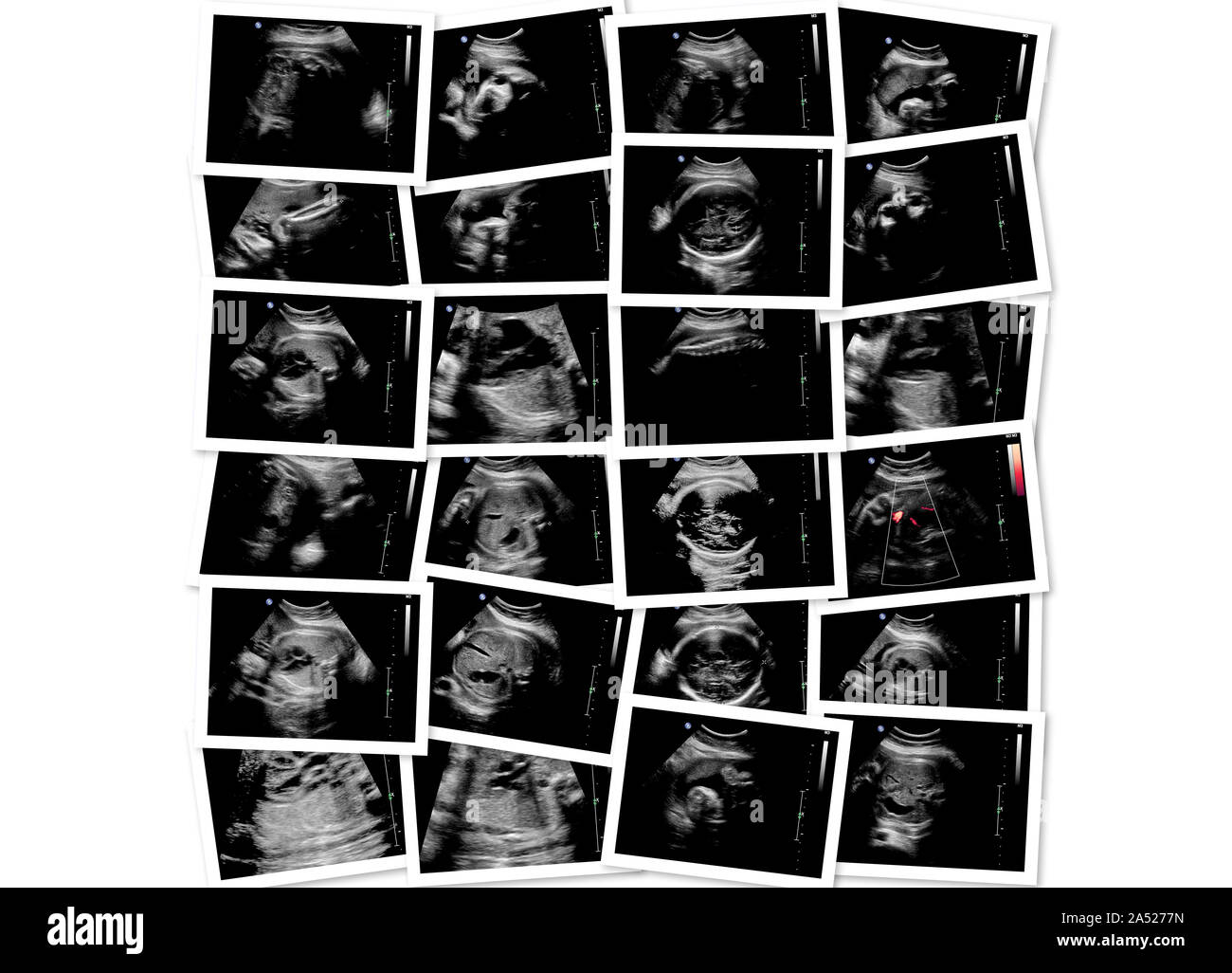 Sammlung von Bildern aus Ultraschalluntersuchung scannen. Fetus im 7. Monat Stockfoto