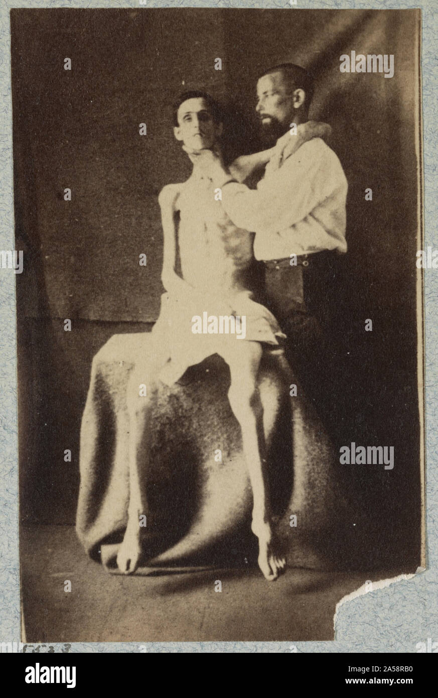 Nicht identifizierte abgemagert Kriegsgefangenschaft, aus der Haft in Belle Isle, Richmond freigegeben, auf den US-General Hospital, Div. 1, Annapolis Stockfoto