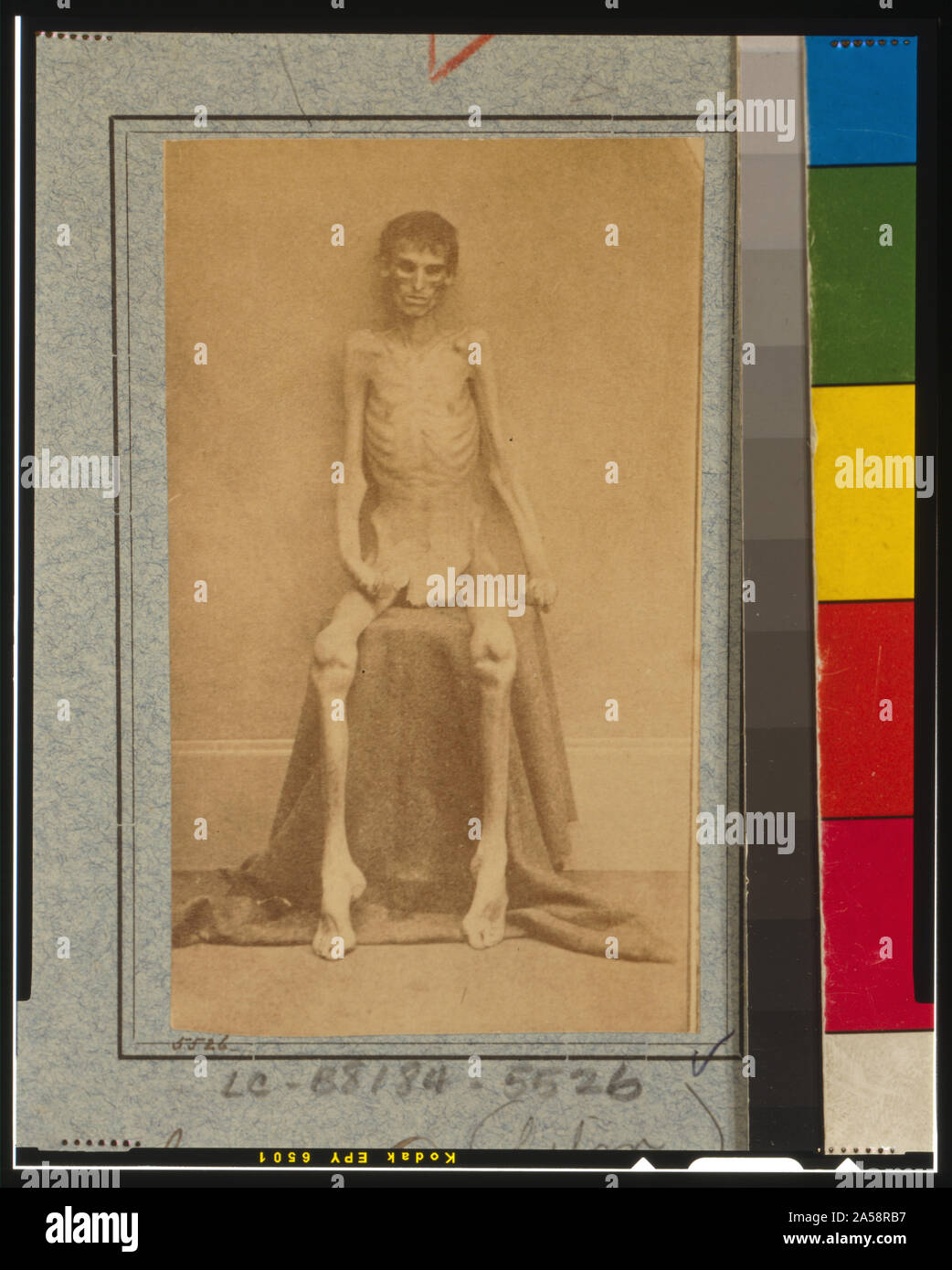 Nicht identifizierte abgemagert Kriegsgefangenen, von Belle Isle, Richmond, auf den US-General Hospital, Div. 1, Annapolis Stockfoto