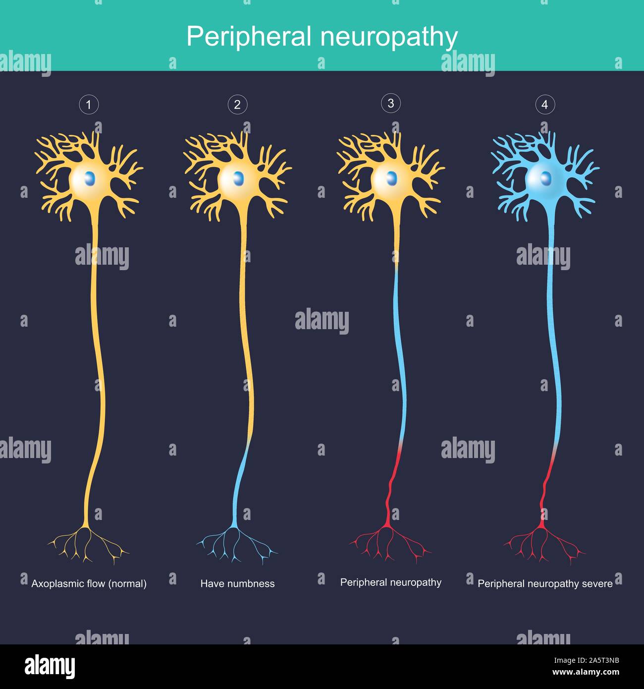 Periphere Neuropathie. Abbildung erklären für die periphere Neuropathie haben taubheitsgefühl bis schwere Entzündung. Stock Vektor