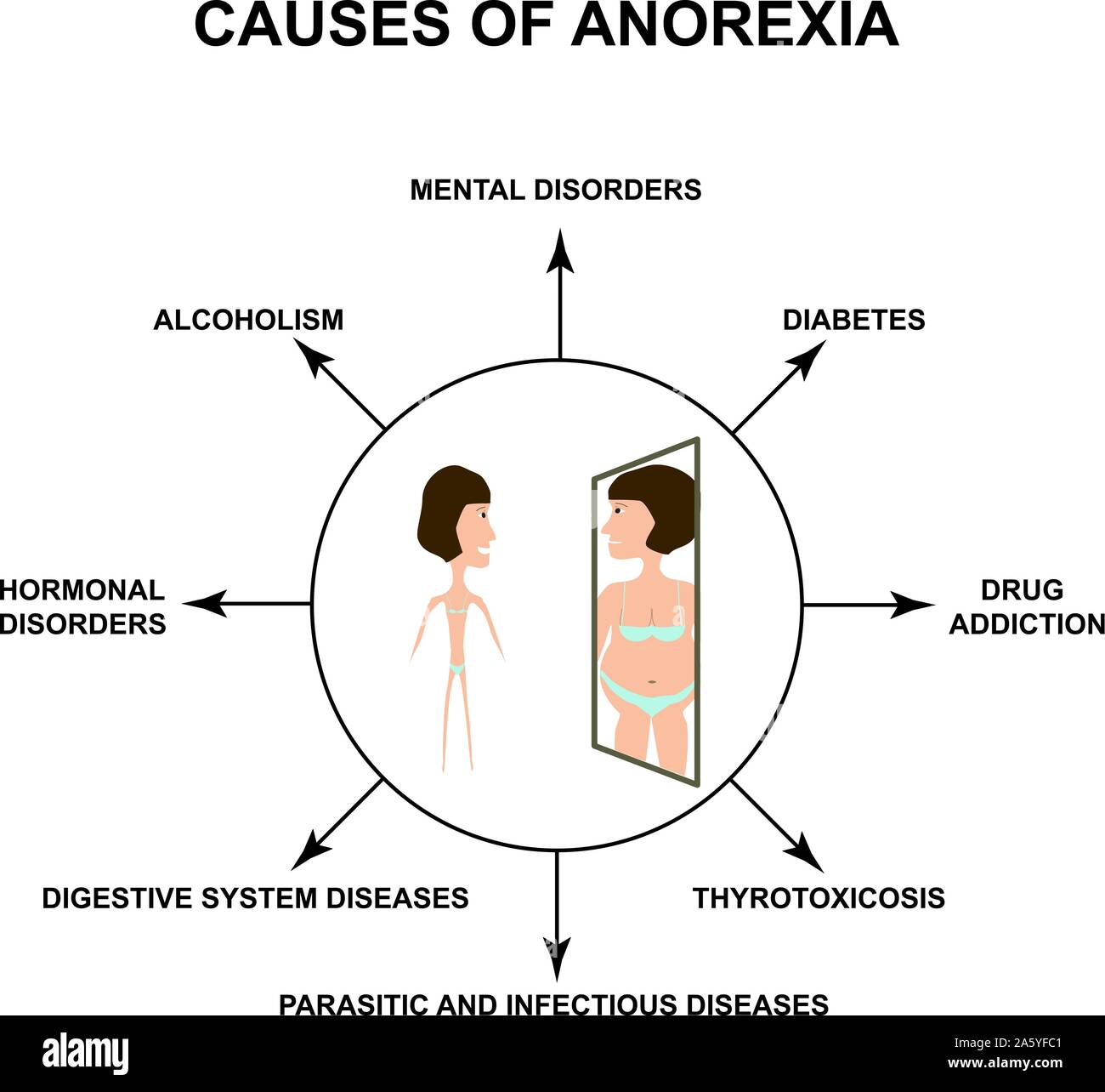 Ursachen der Anorexie. Schlanken Körperbau mit Magersucht. Reflexion der Fettleibigkeit in den Spiegel. Infografiken. Vector Illustration auf isolierte Hintergrund. Stock Vektor