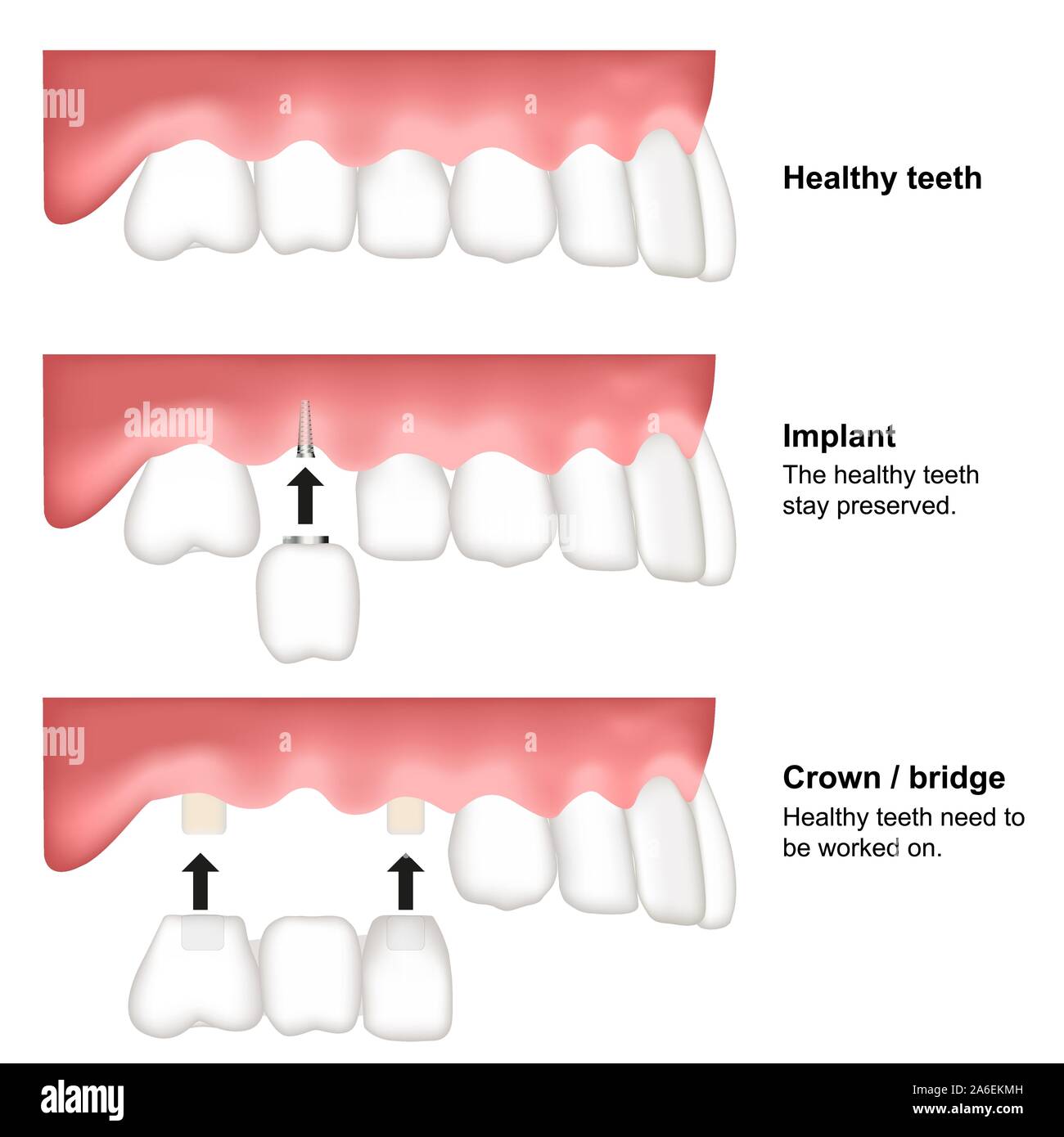 Zahnersatz Dental Medical Vector Illustration auf weißem Hintergrund Stock Vektor