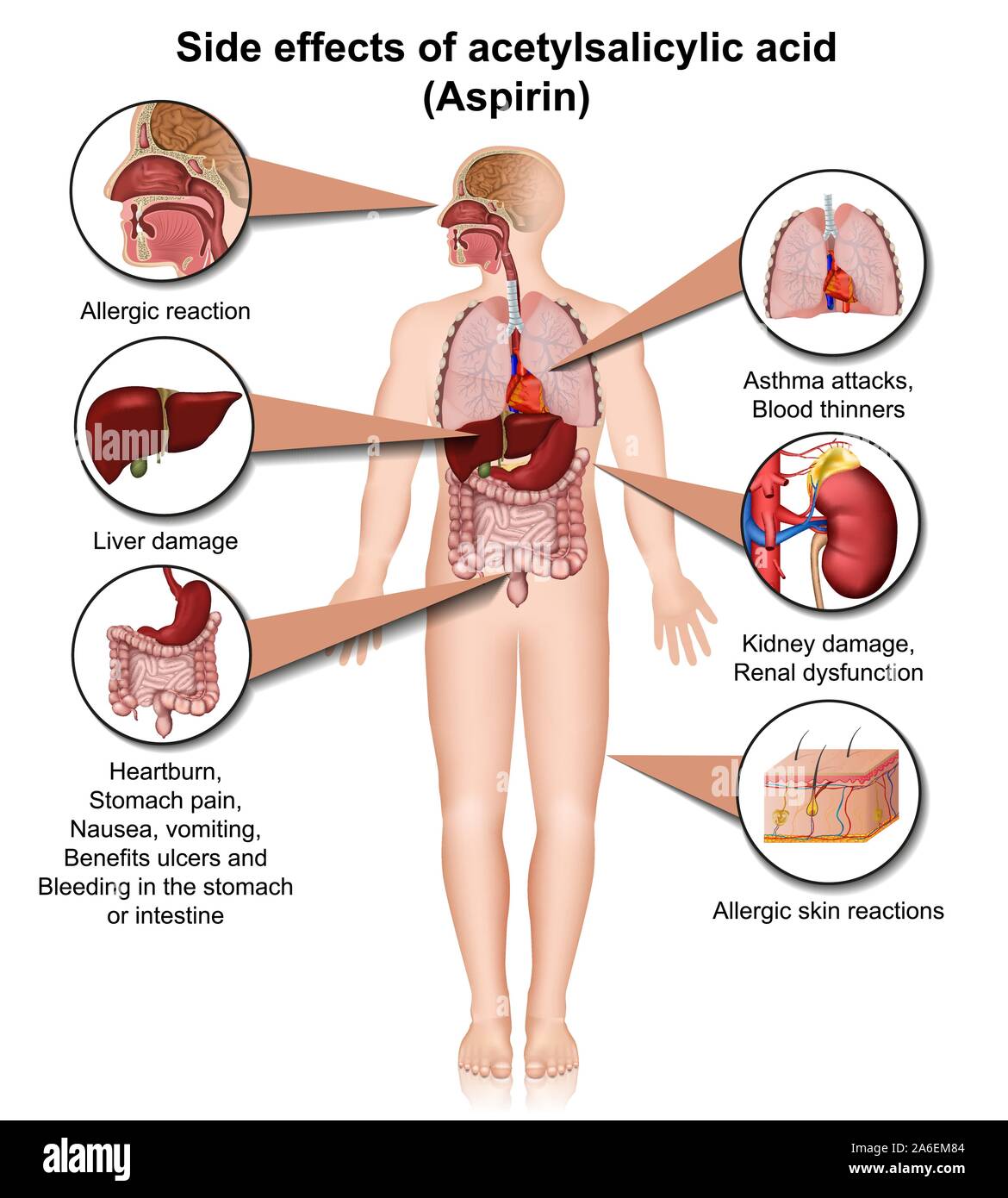 Aspirin Körper Effekte 3 d medical Vektor Infografik auf weißem Hintergrund Stock Vektor