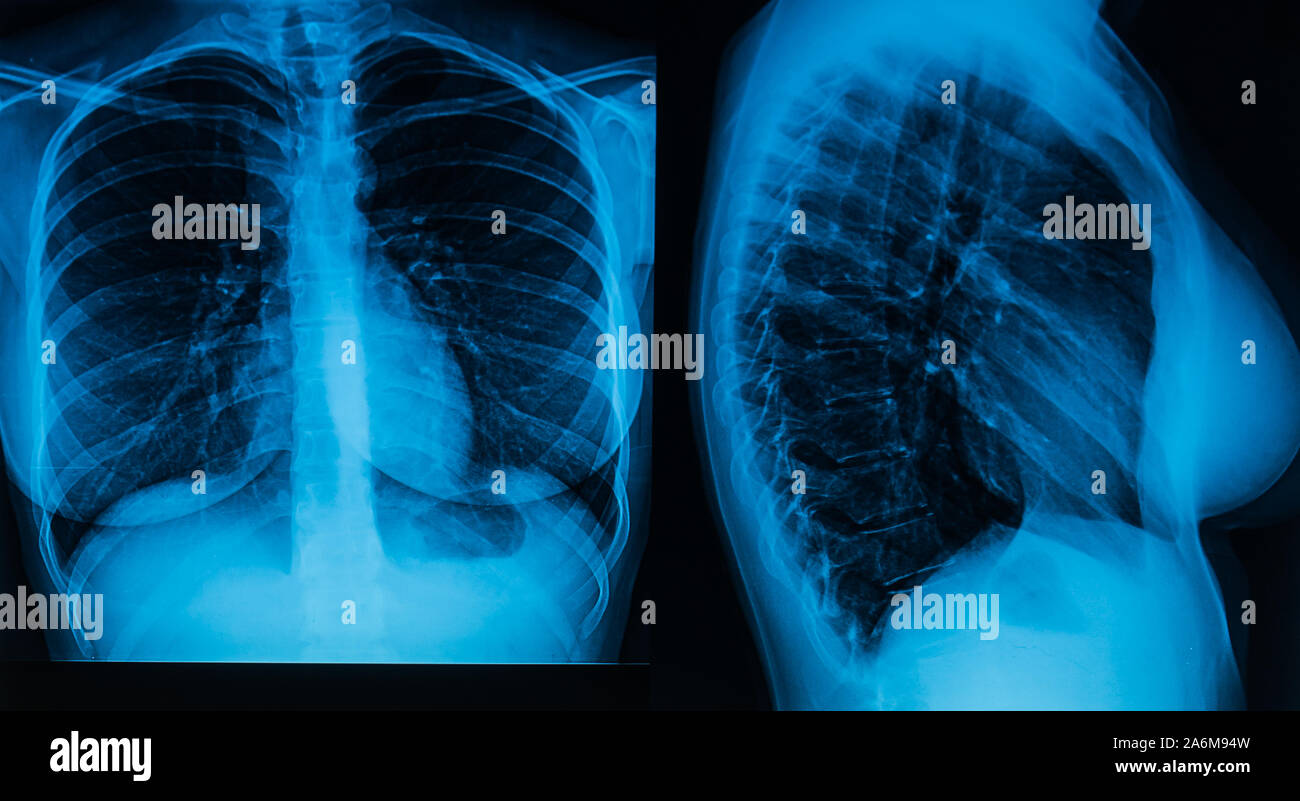 Einer Frau, die Röntgenaufnahme des Thorax in zwei Projektionen. Konzept der Prävention und Bekämpfung von Lungenkrankheiten Stockfoto
