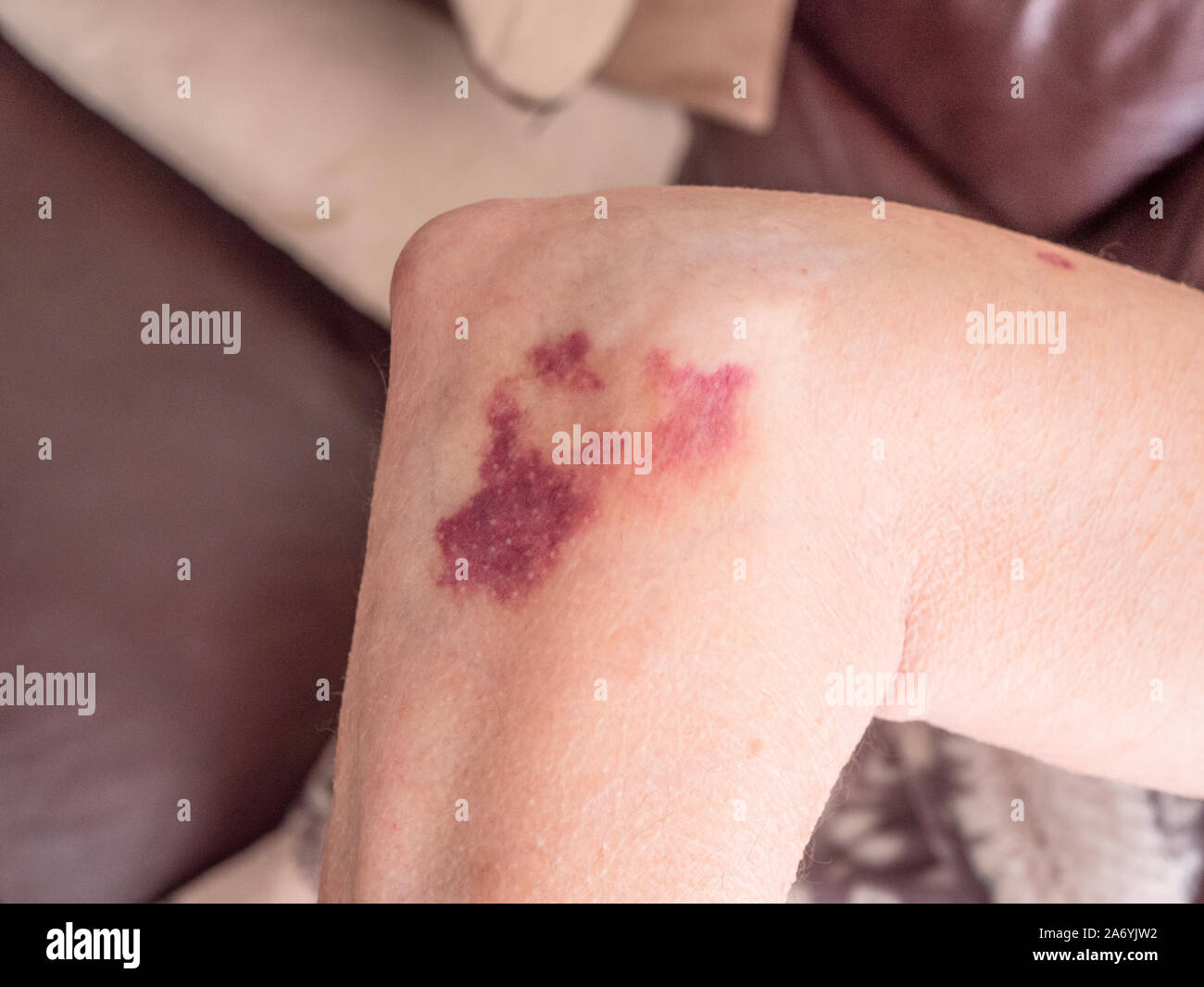 Beispiel der Blut Fleck und Blutergüsse an der reife weibliche Arm verursacht Blut verdünnende Medikamente auf minimalen Kontakt mit einer harten Oberfläche. Stockfoto