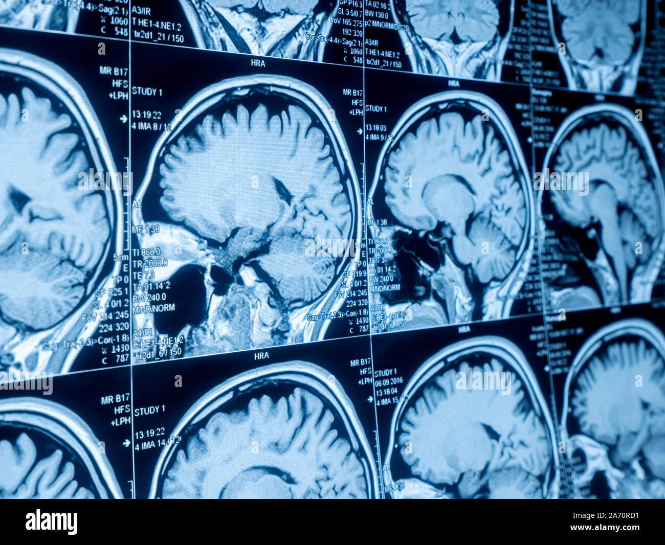 Die Magnetresonanztomographie (MRT) des Gehirns Stockfoto