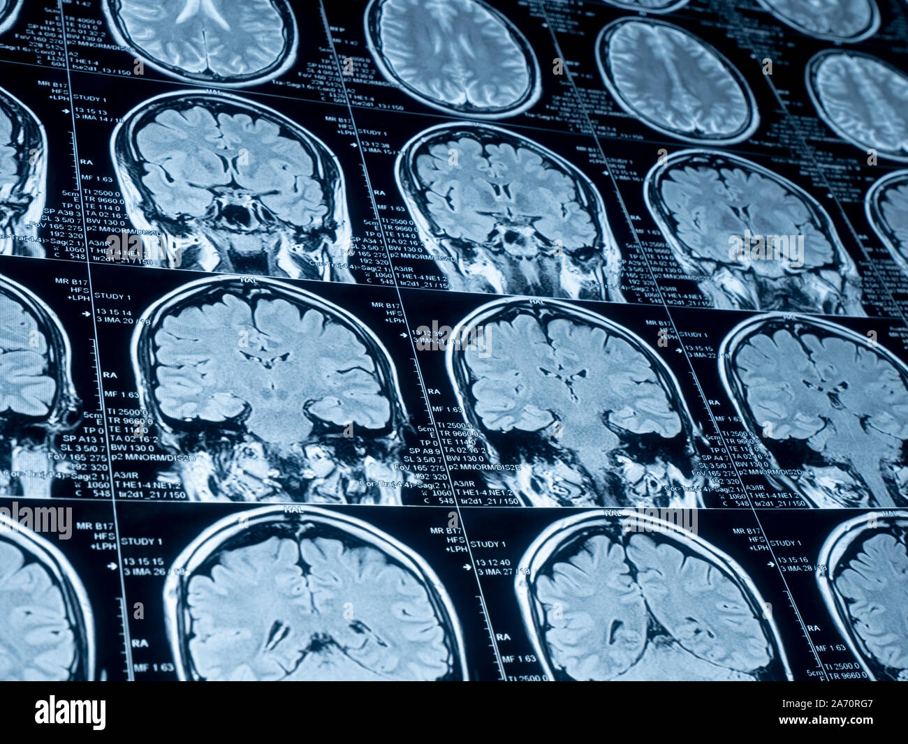 Die Magnetresonanztomographie (MRT) des Gehirns Stockfoto