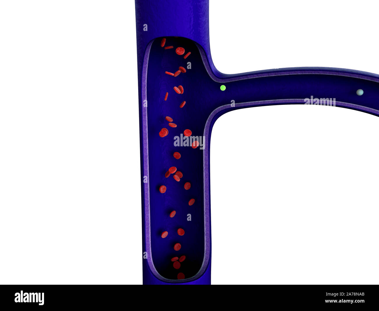 Arterie mit einem abgetrennten Bereichs, hochwertige Rendering mit original Texturen und Global Illumination, Kontraktion der Blutgefäße dargestellt Stockfoto