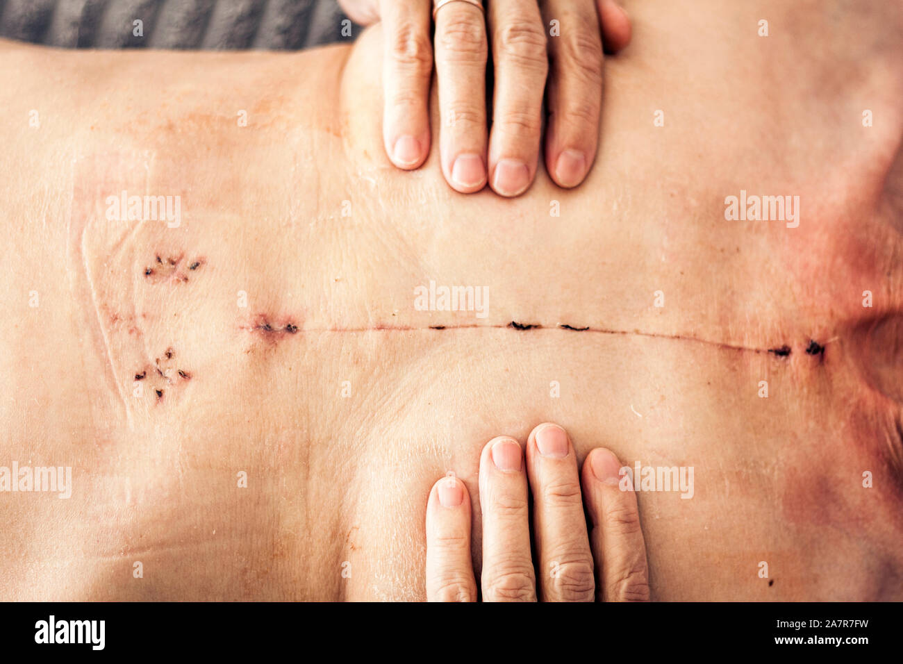Narbe Patient Brust Wunde Operation Stockfotos Und Bilder Kaufen Alamy