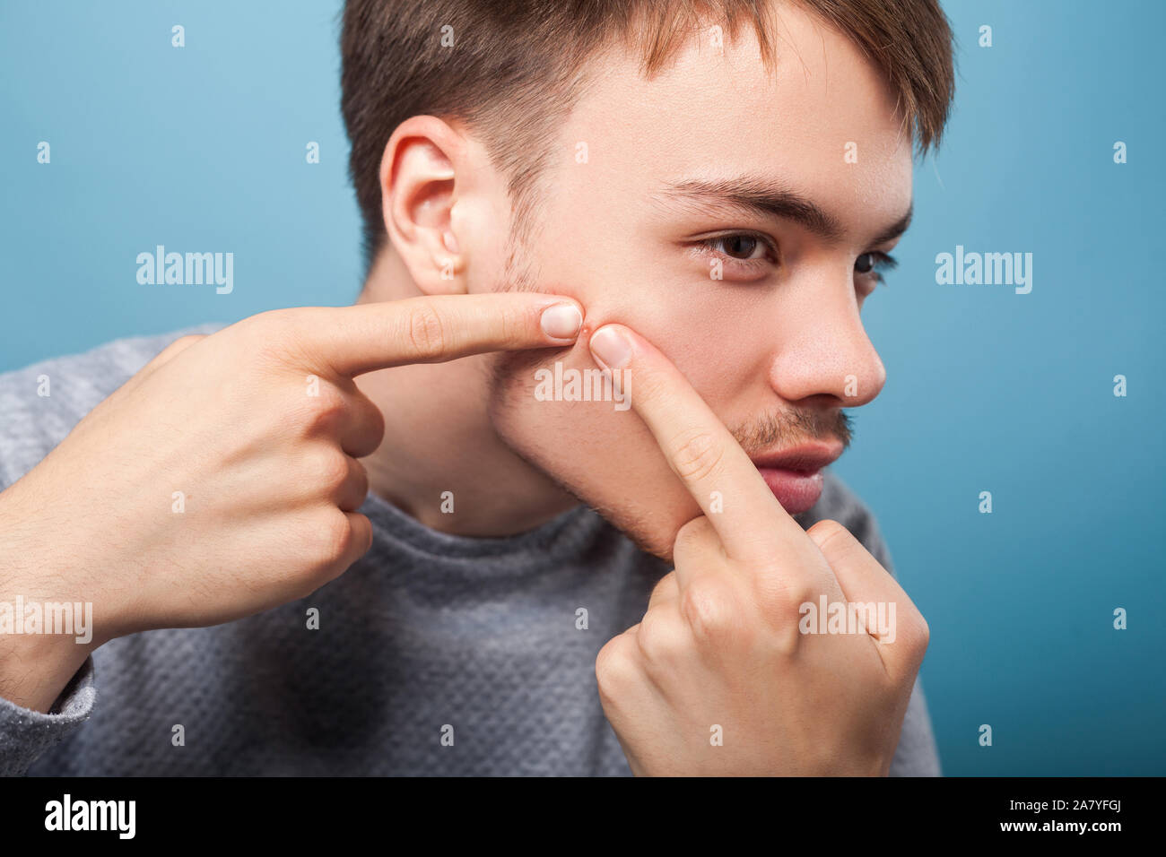Hygiene und Hautprobleme. Porträt der jungen brünetten Mann mit Borsten und Schnurrbart quetschen Pickel im Gesicht, leiden Akne, männliche Hautpflege Konzept. Ich Stockfoto