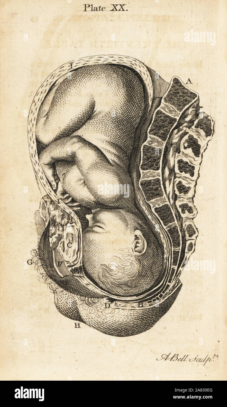 Fetus Kopf im Gegenteil Position im Geburtskanal während der Arbeit. Kupferstich von Andrew Bell nach einer Illustration von Jan van Rymsdyk von William Smellie eine Reihe von anatomischen Tabellen, Charles Elliot, Edinburgh, 1780. Stockfoto