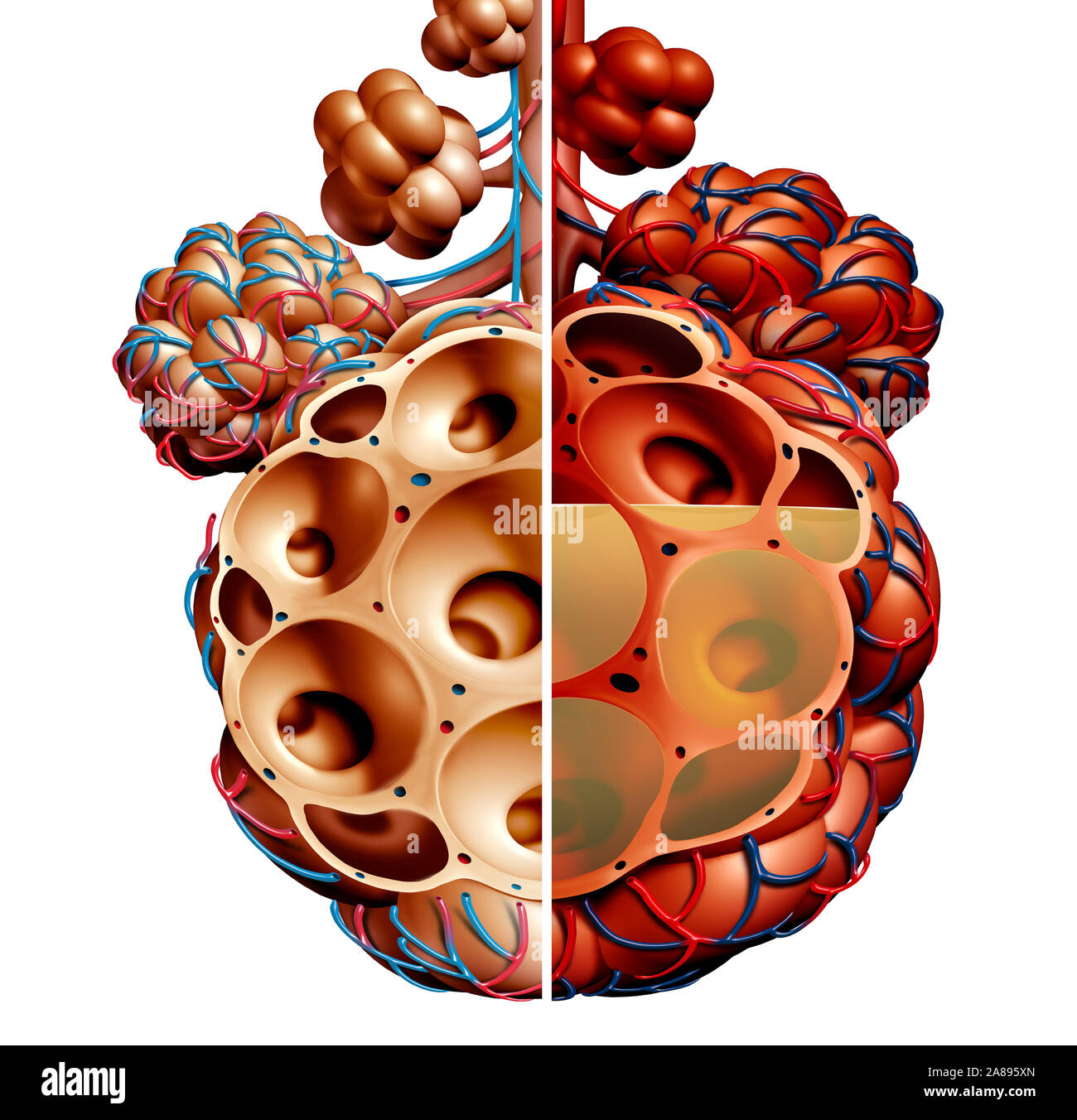 Pneumonie und Lungenbläschen mit Flüssigkeit Diagramm oder alveolus Entzündung Anatomie Diagramm als medizinisches Konzept von gesunden und ungesunden Lunge. Stockfoto