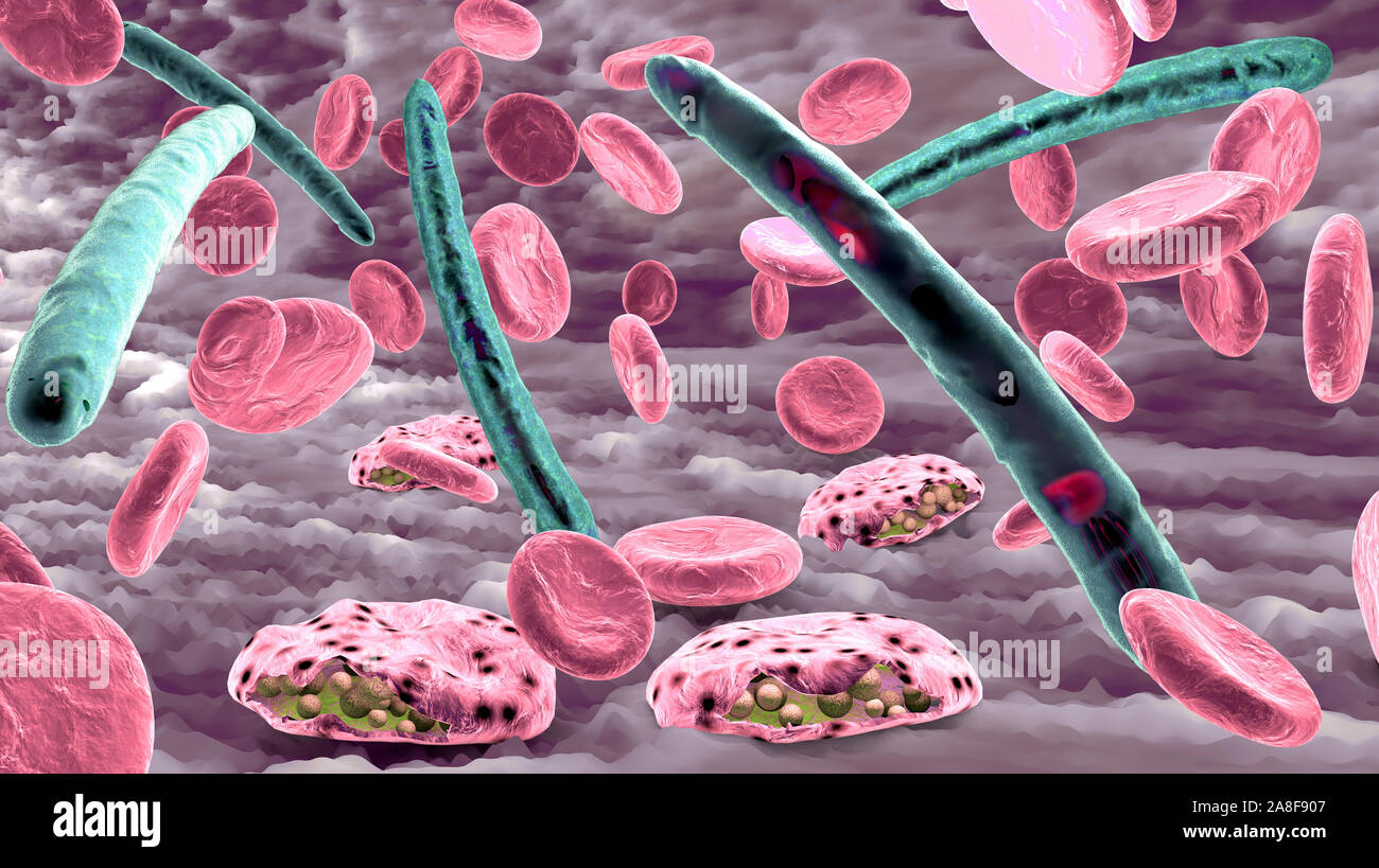 Malaria Infektion, Abbildung Stockfoto