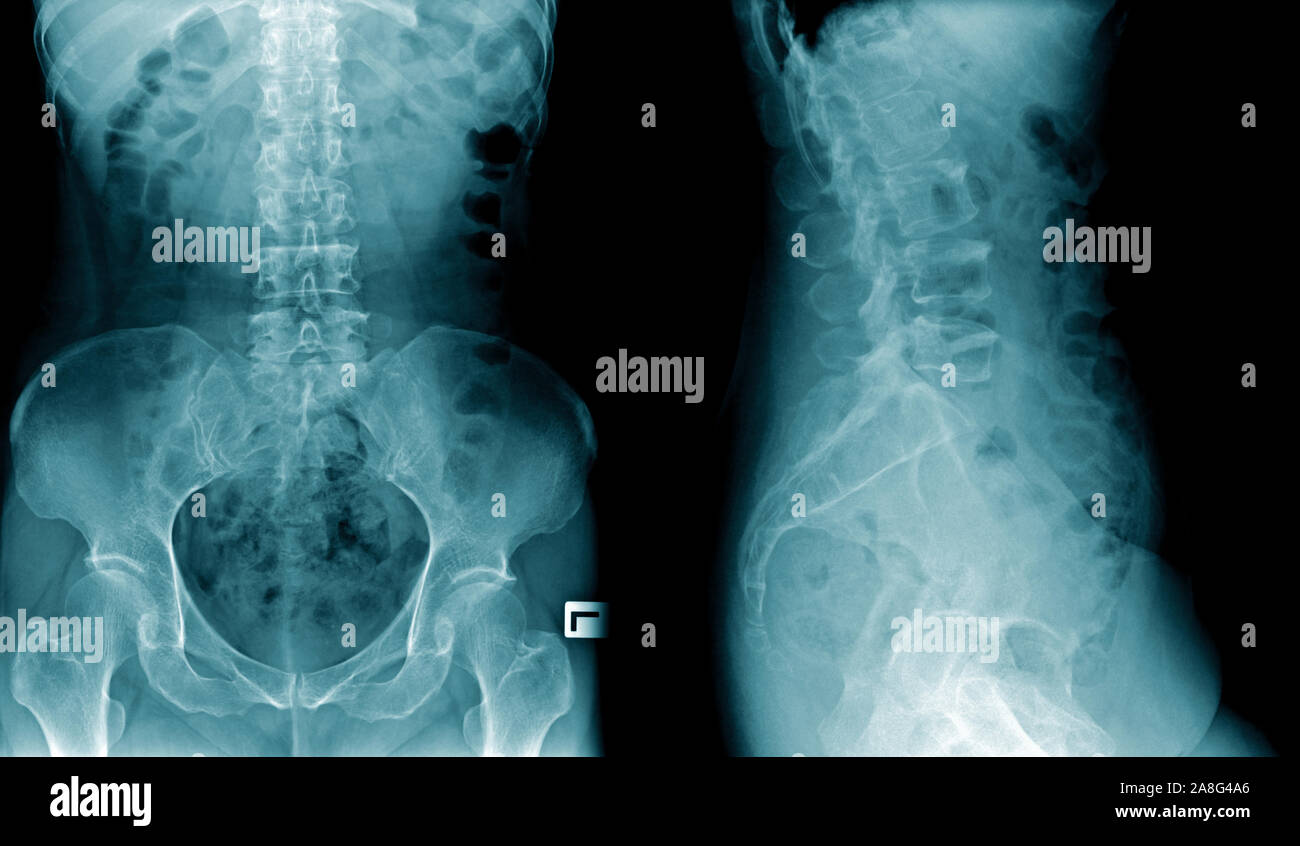 X-ray Image der menschlichen Wirbelsäule AP und seitlich in Blautönen auf schwarzem Hintergrund Stockfoto