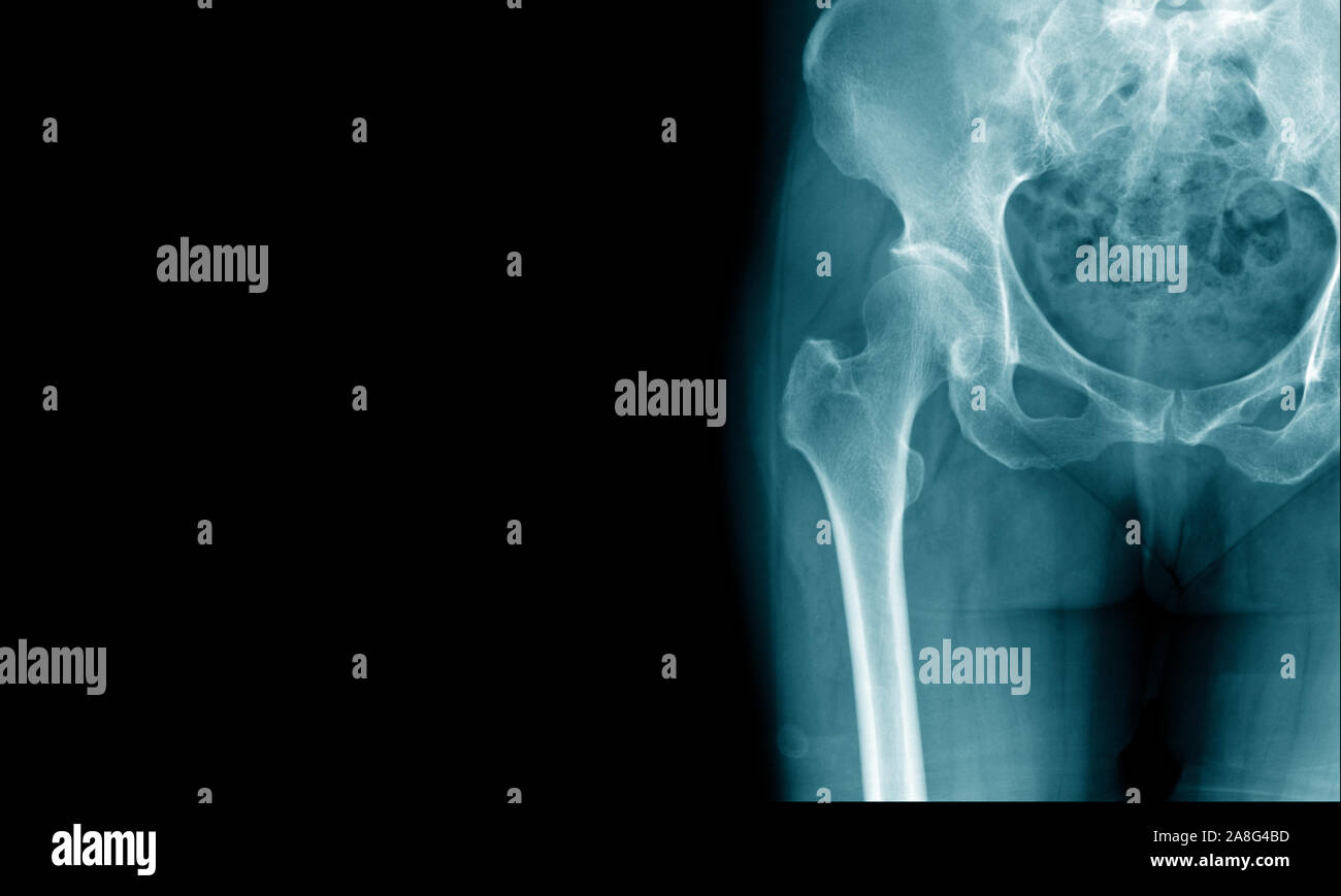 Röntgenbild der Hüfte und degenerative Veränderungen oder avaskuläre Nekrose hip zeigen Stockfoto