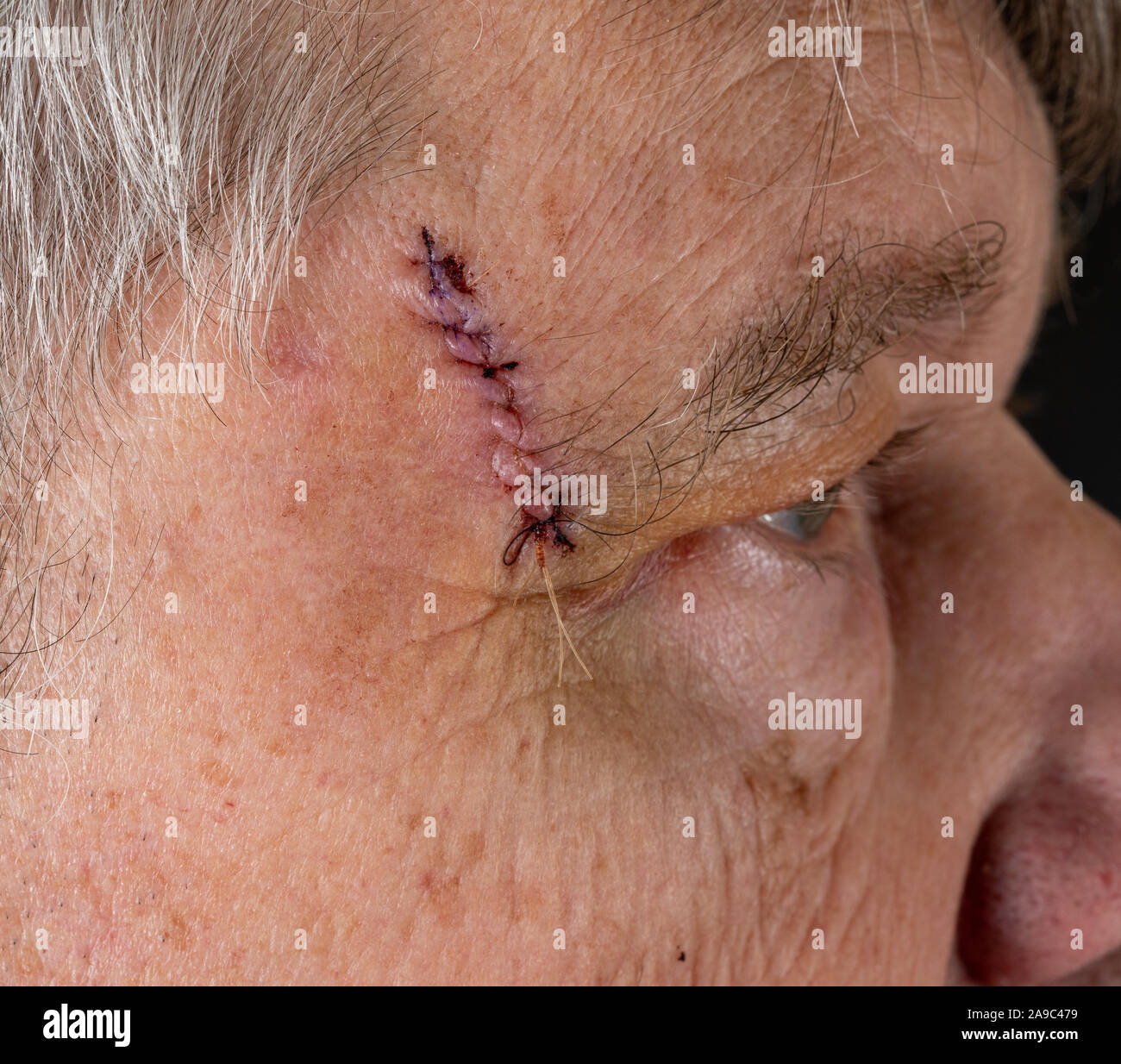 Ältere Erwachsene männliche mit Stichen in den Schnitt nach der Operation zur Entfernung von basalzellkarzinom durch Sonne verursachte Schäden Stockfoto