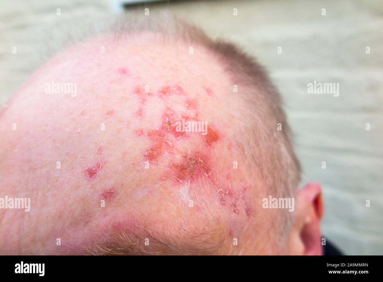 Stirn-/Kopf- und Kopfhaut eines Mannes, dessen Aktinische Keratose Hautläsionen (langfristige Sun Schäden an der Haut durch UV-Strahlung) mit Efudix Creme behandelt wurde der abnormen und möglicherweise bereits Krebszellen töten. (114) Stockfoto