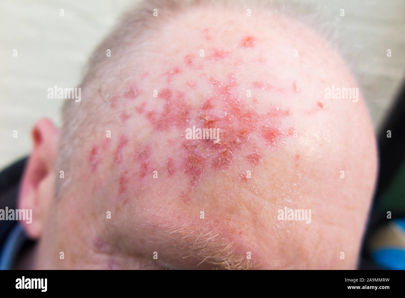 Aktinische Keratose Stockfotos und bilder Kaufen Alamy