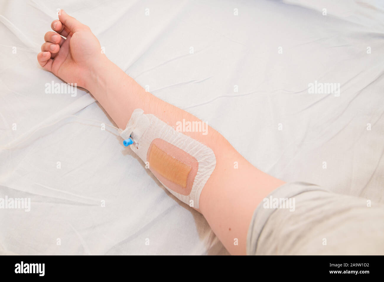 Infusion Ins Gewebe Gelaufen Was Tun www.alamy.de