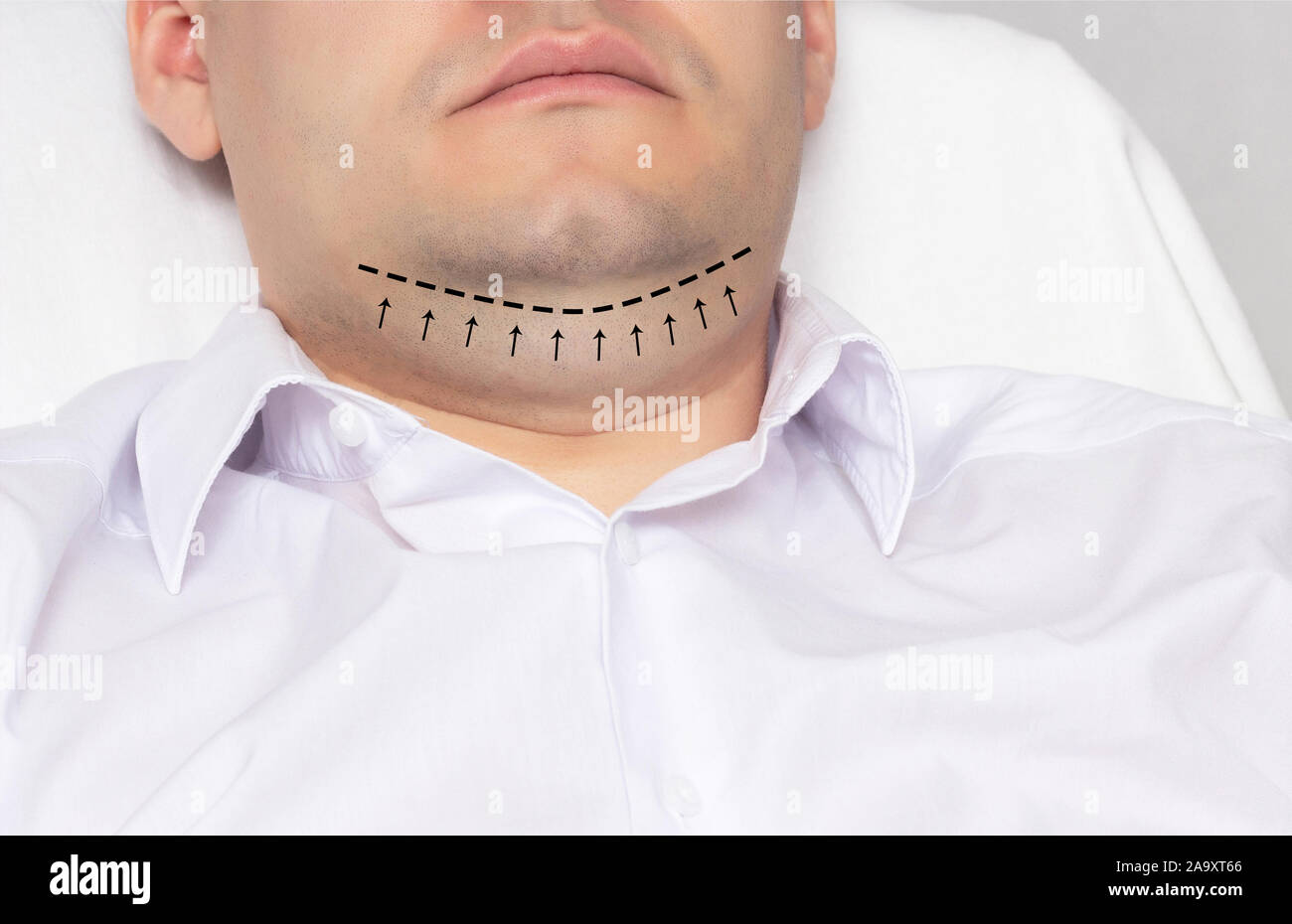 Ein Mann mit einem doppelkinn im Büro eines plastischen Chirurgen. Die Kennzeichnung mit einem schwarzen Strich-Punkt Markierung für doppelkinn Ausbau, anaplasty Stockfoto