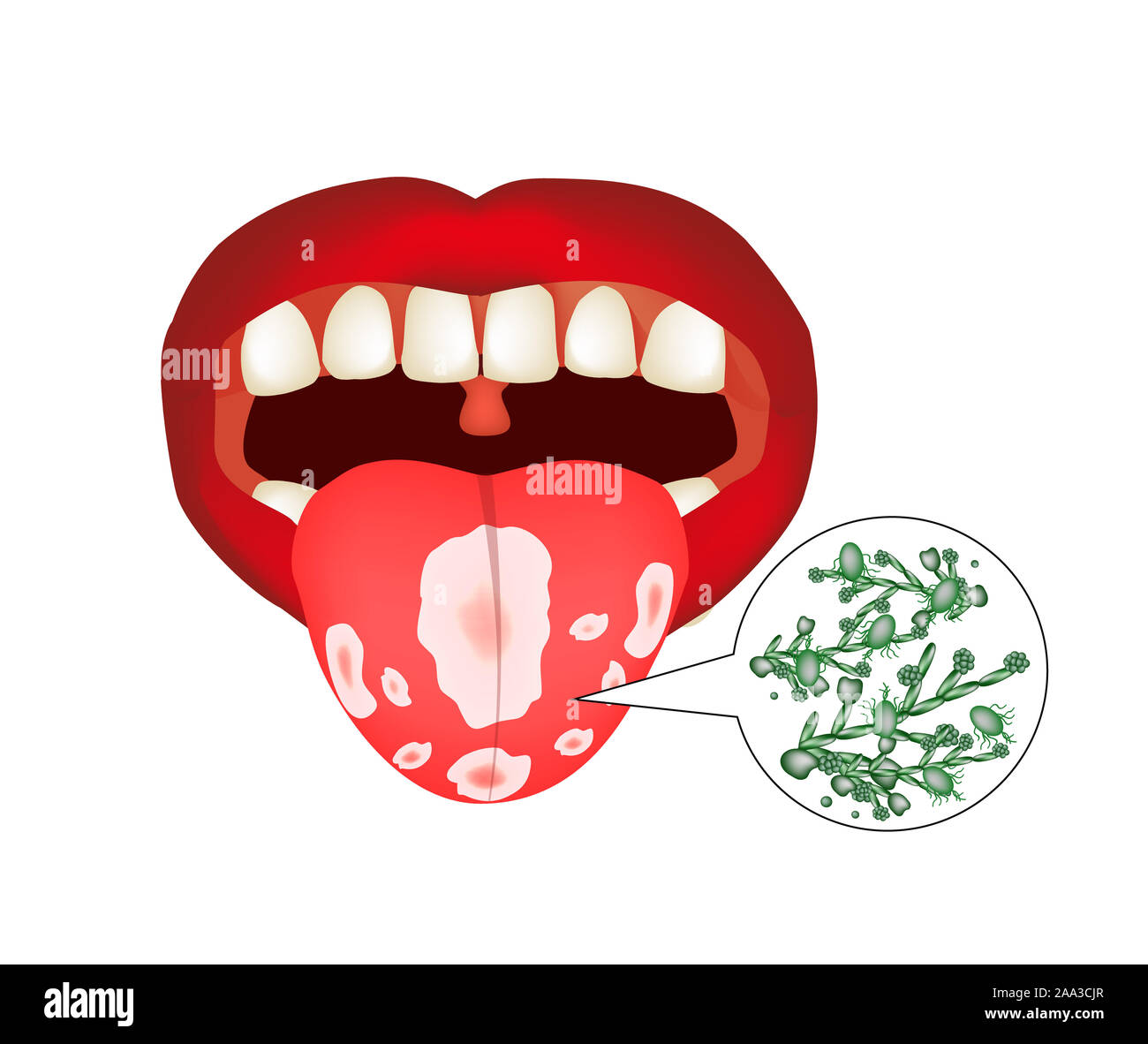 Mundsoor. Candidiasis auf der Zunge. Pilz im Mund. Infografiken. Abbildung auf isolierte Hintergrund. Stockfoto