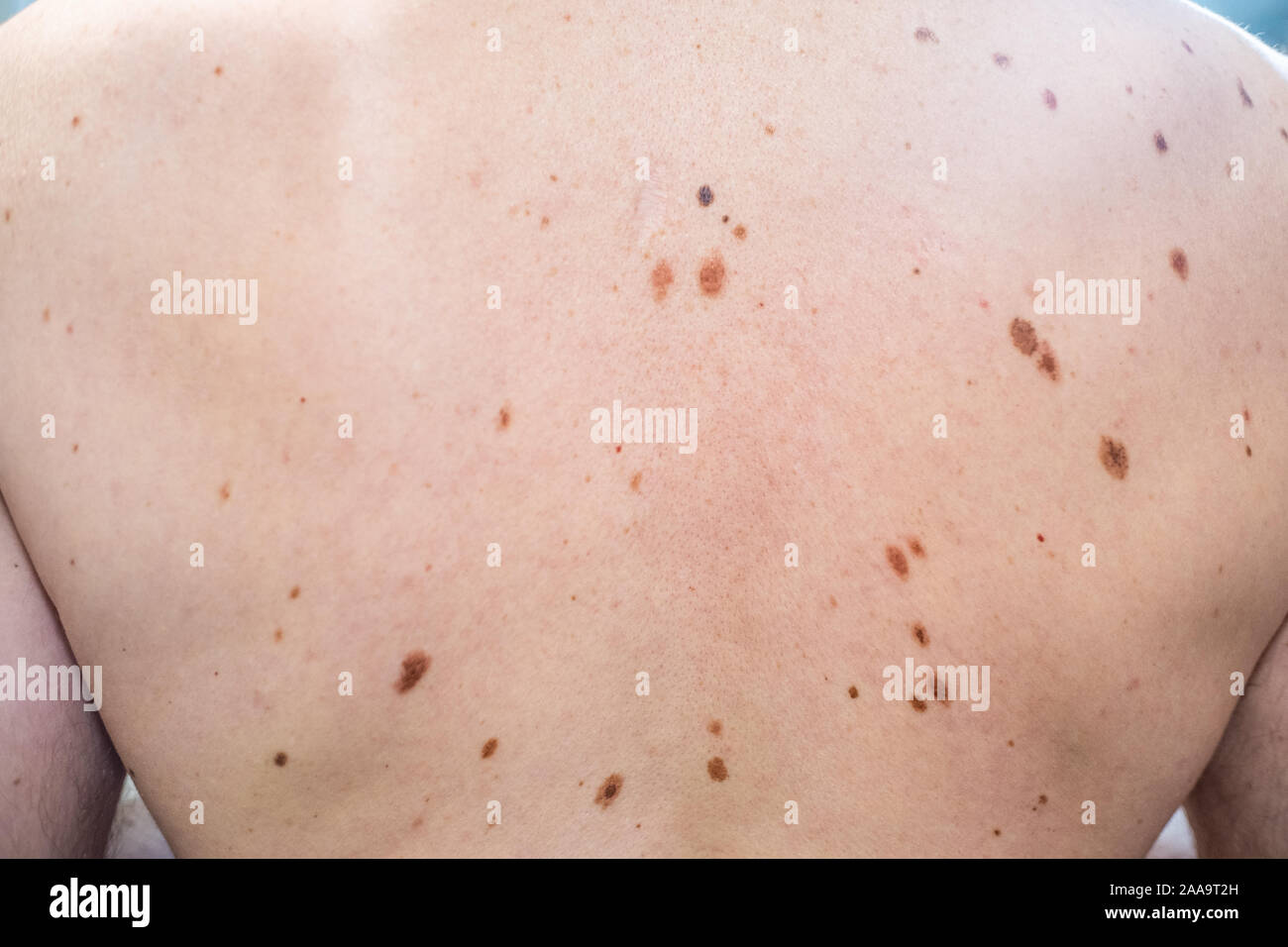 Auch ein melanocytic Nevus als nevocytic oder nevus-cell Nevus und allgemein als Maulwurf ist eine Art von Melanocytic Tumors bekannt Stockfoto