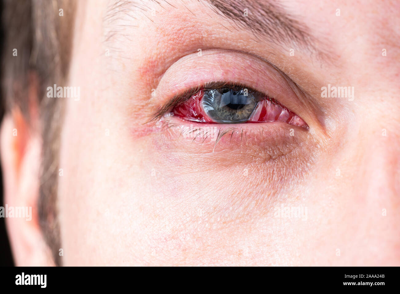 Augenblutung Stockfotos und -bilder Kaufen - Alamy