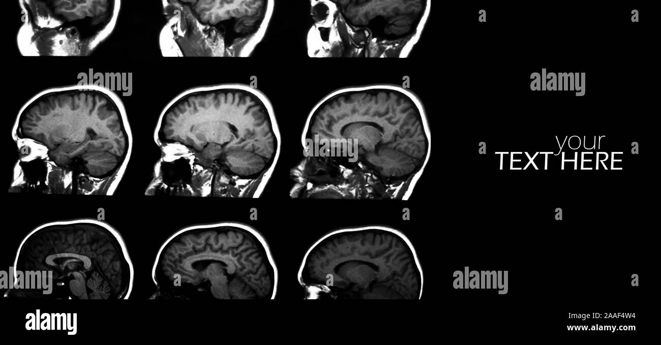 Gehirn MRT-Scan auf dem Schwarzen Stockfoto