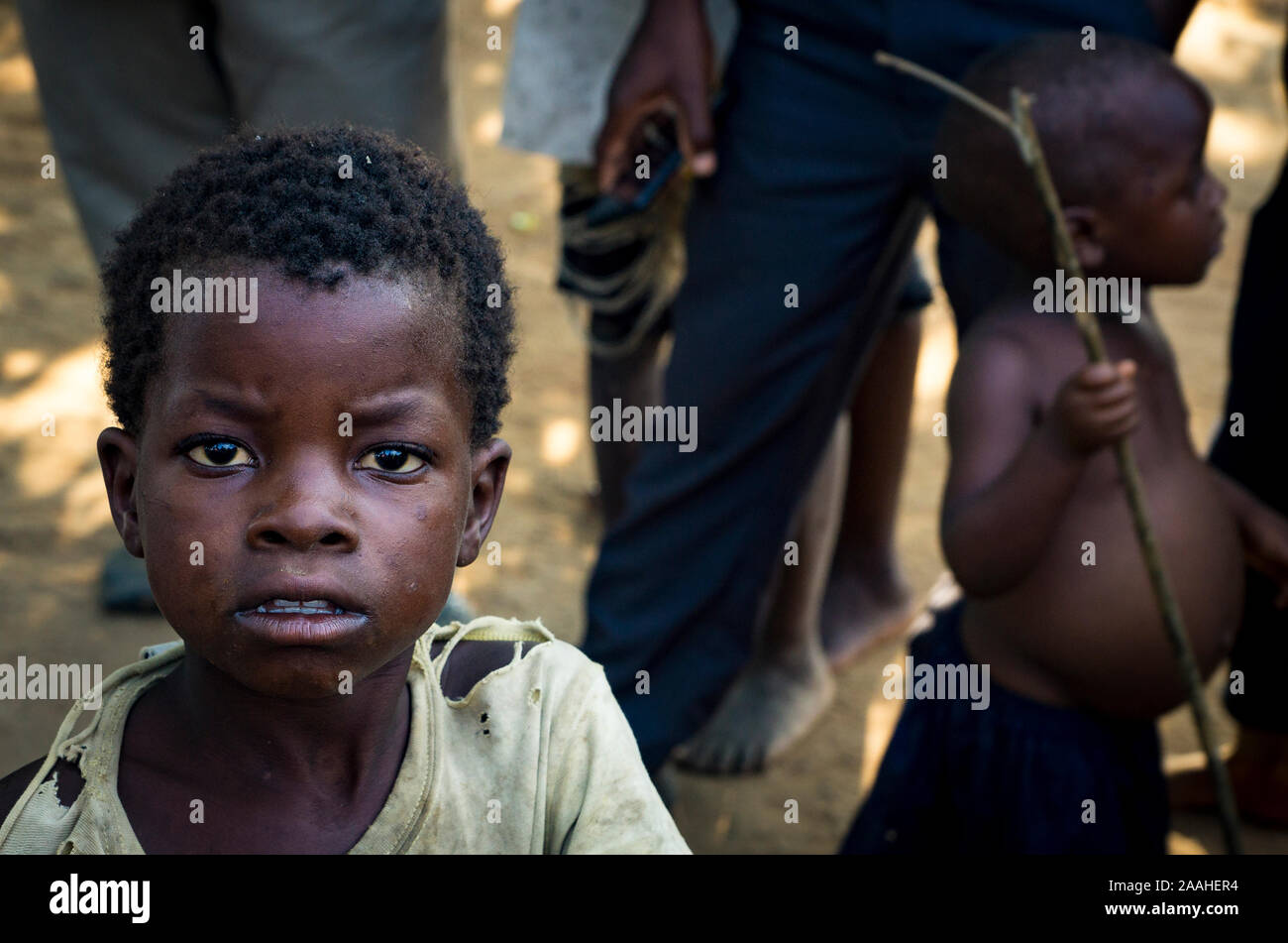 Eine malawische Kind starrt Kamera (Kind mit kwashiokor im Hintergrund) Stockfoto