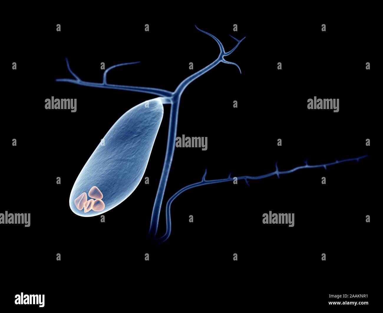 Gallenblase Steine, computer Abbildung. Stockfoto