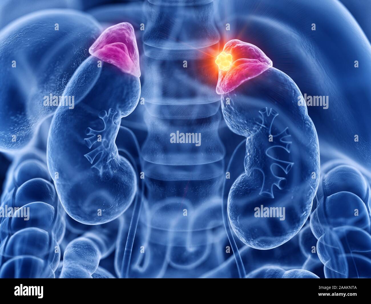 Nebenniere Krebs, computer Abbildung. Stockfoto